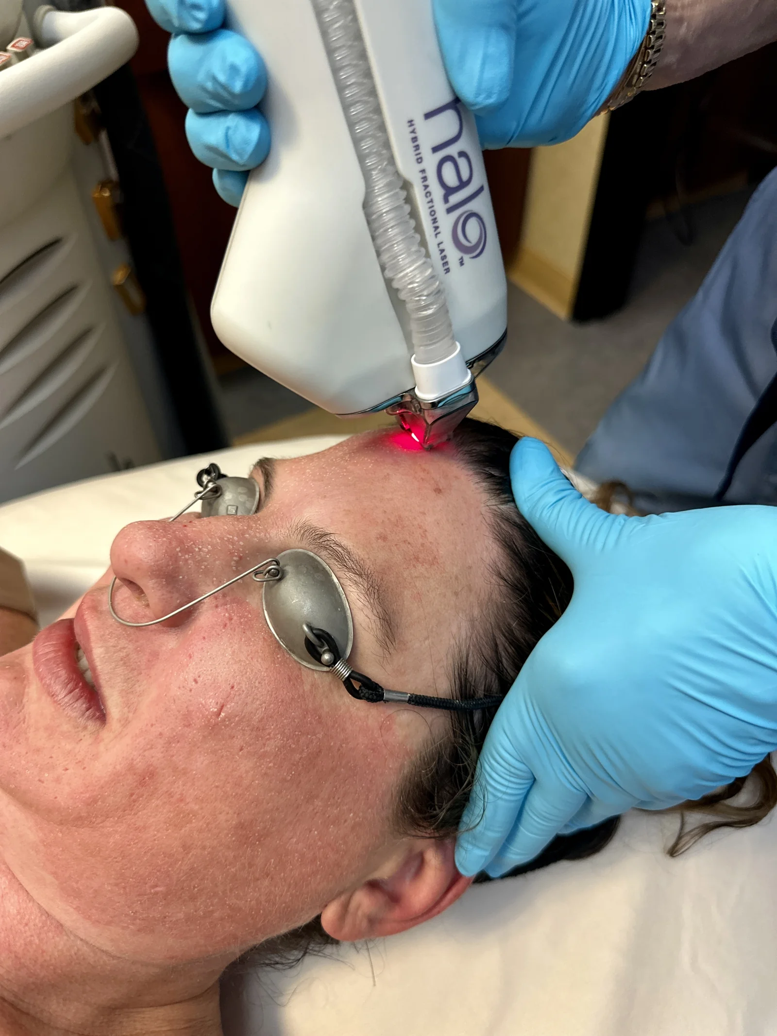 A Halo hybrid fractional laser resurfacing session in progress at Reviv Med Spa, Millbrae, California
