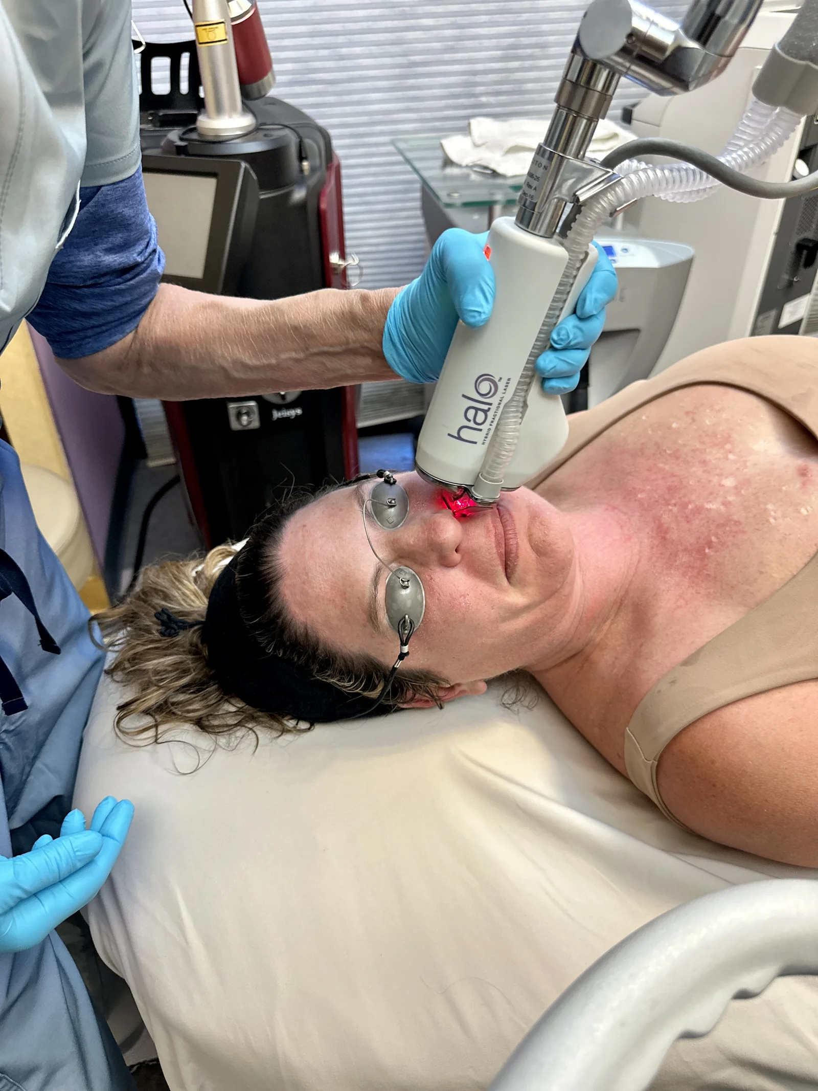 Sciton Halo hybrid fractional laser treatment in progress