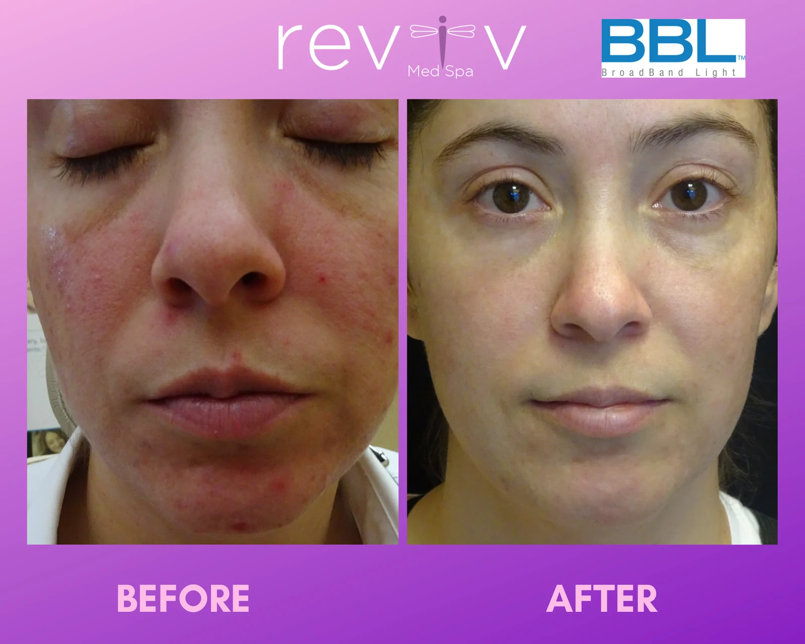 BBL Hero photofacial, before and after — facial redness cleared