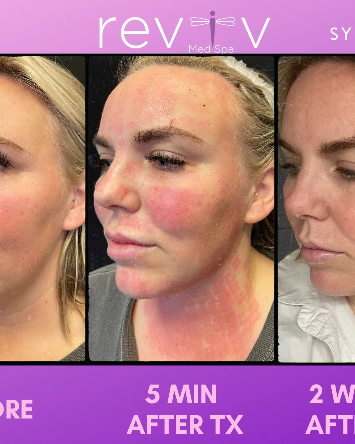 Sylfirm X first-treatment result