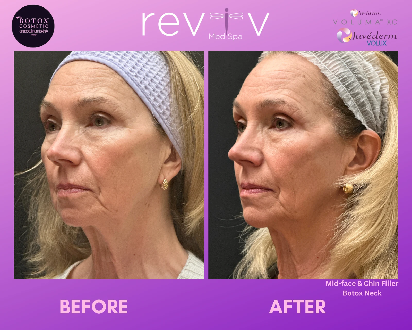 Reviv Med Spa patient before and after — Botox · Neck, Millbrae, California