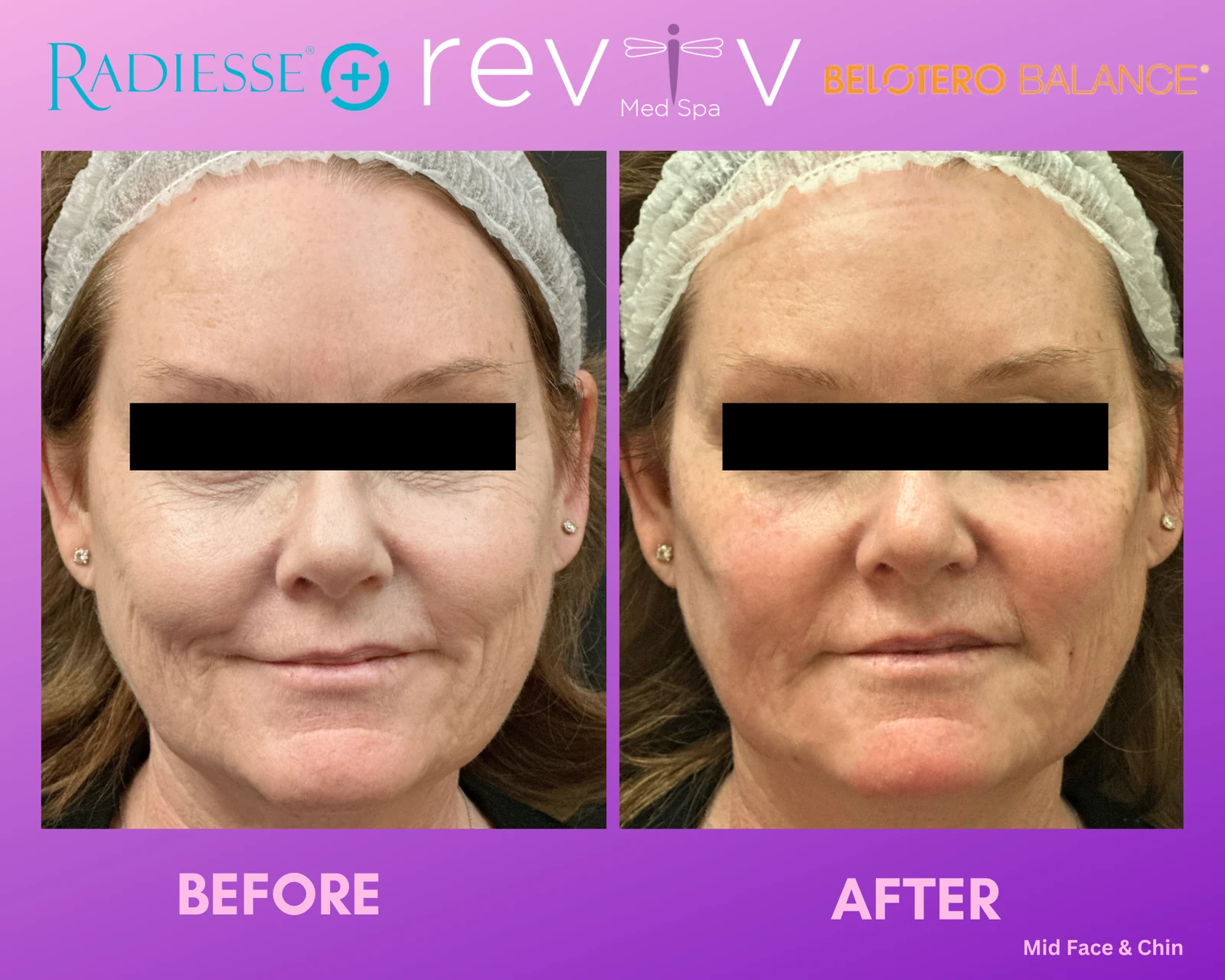 Reviv Med Spa patient before and after — Dermal Fillers, Millbrae, California