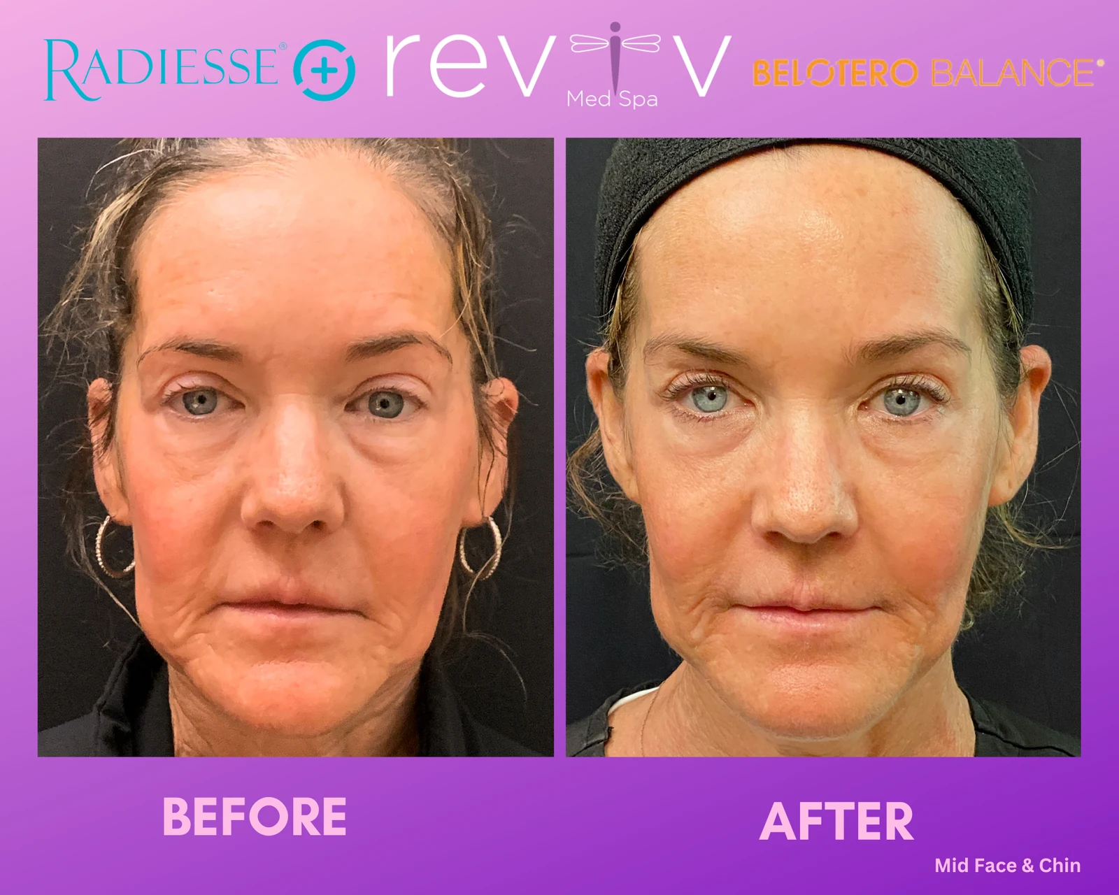 Reviv Med Spa patient before and after — Dermal Fillers, Millbrae, California