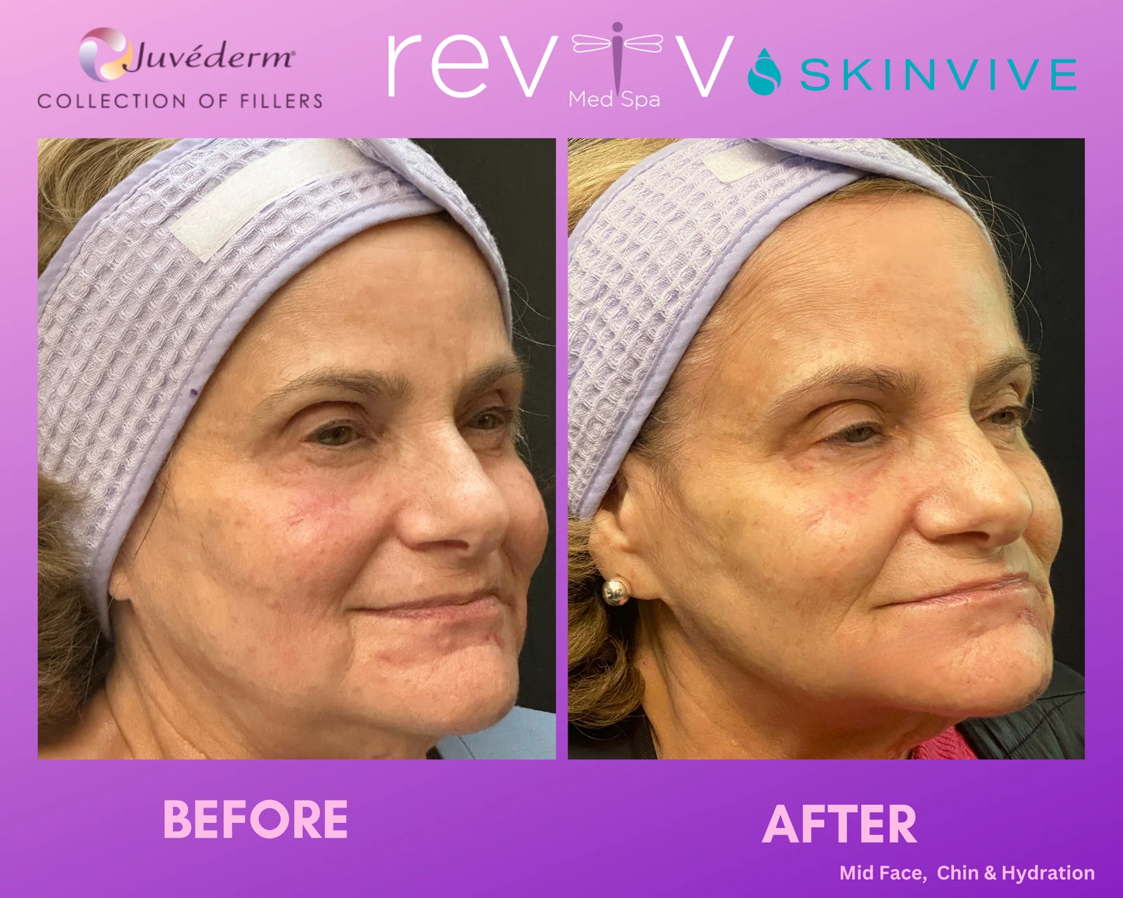 Reviv Med Spa patient before and after — Dermal Fillers, Millbrae, California