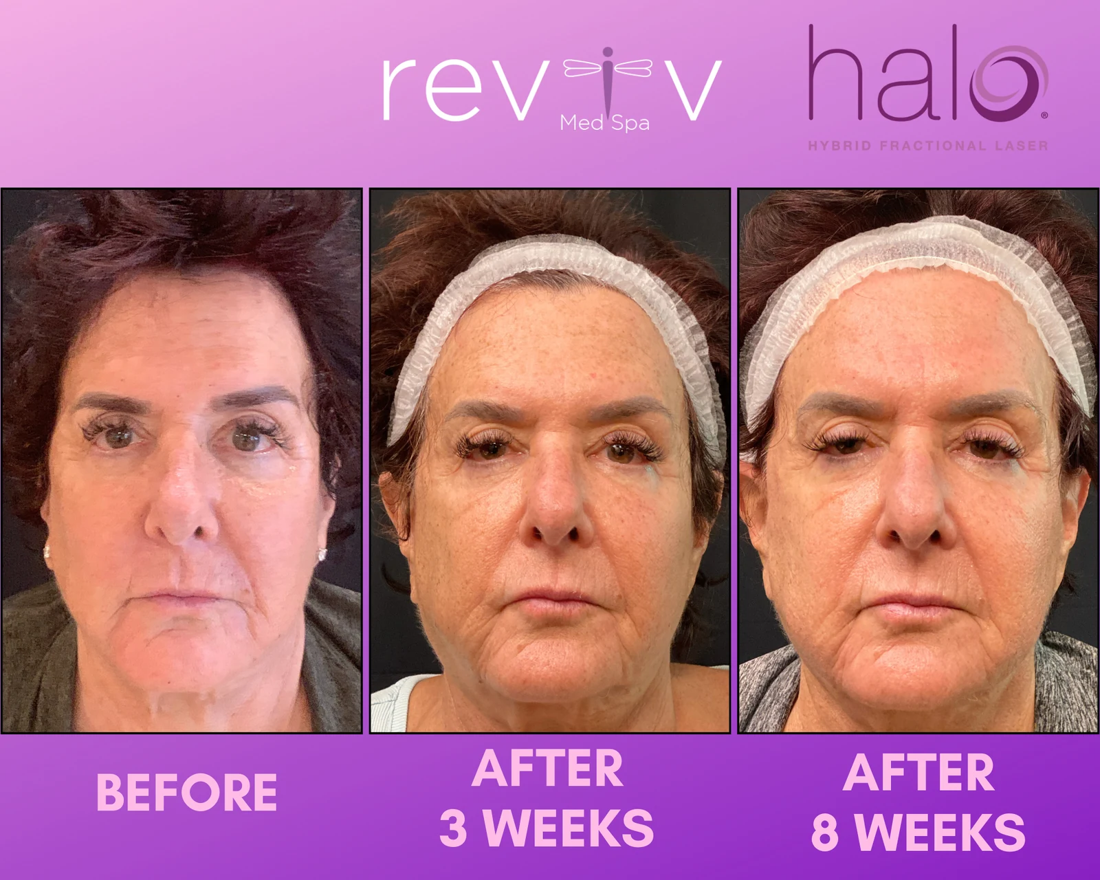 Reviv Med Spa patient before and after — Halo, Millbrae, California