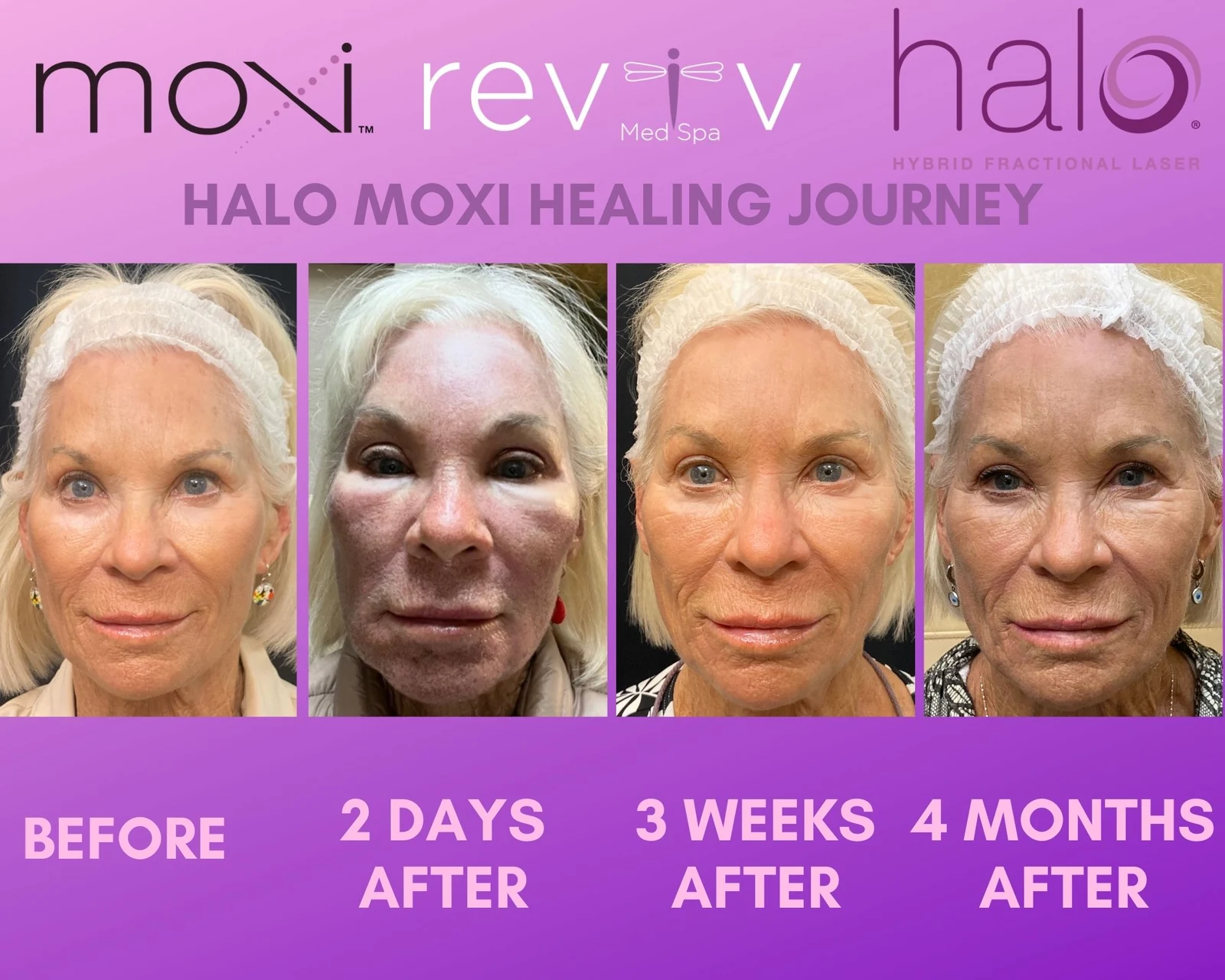 Halo Moxi laser before and after