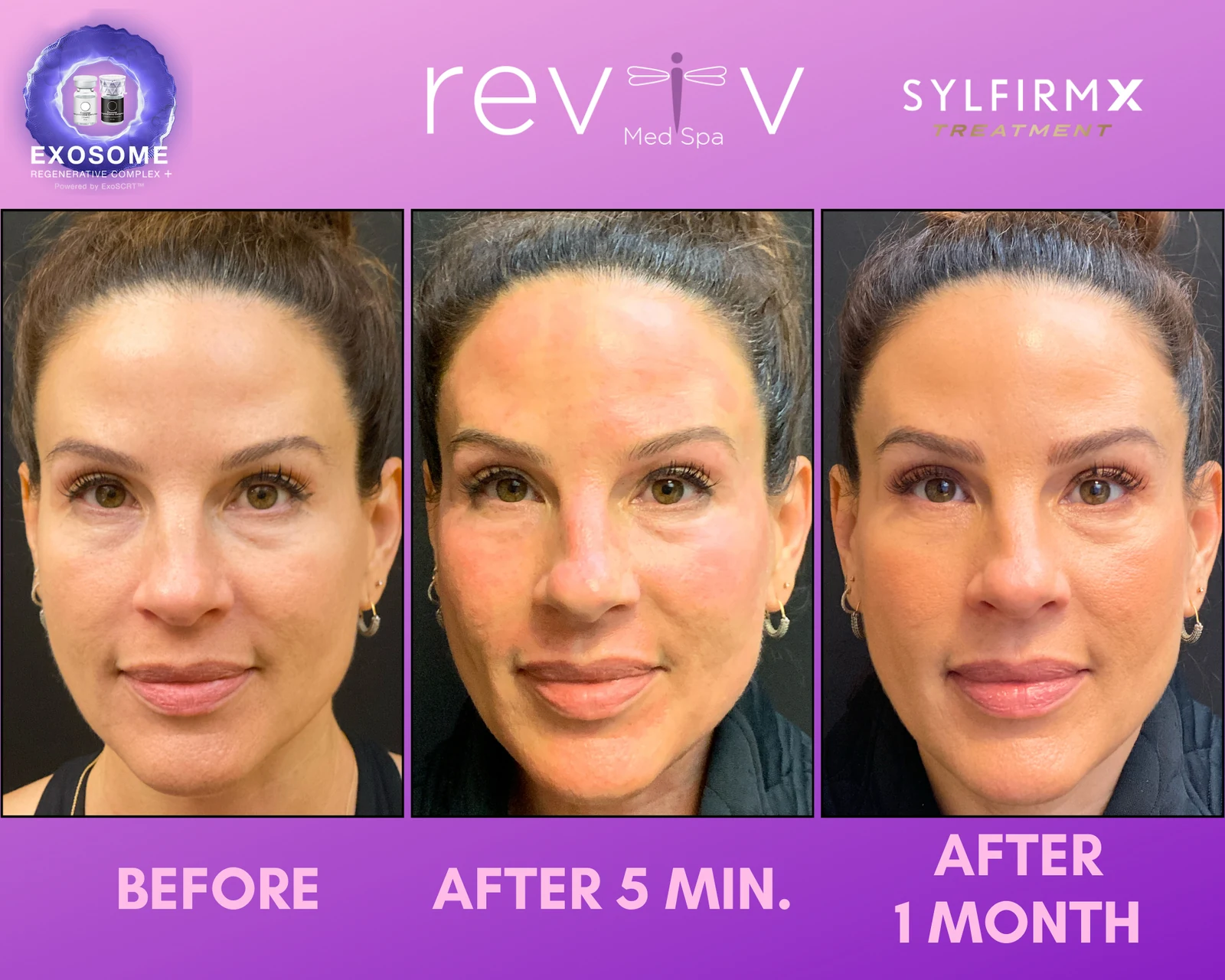 Sylfirm X RF microneedling result