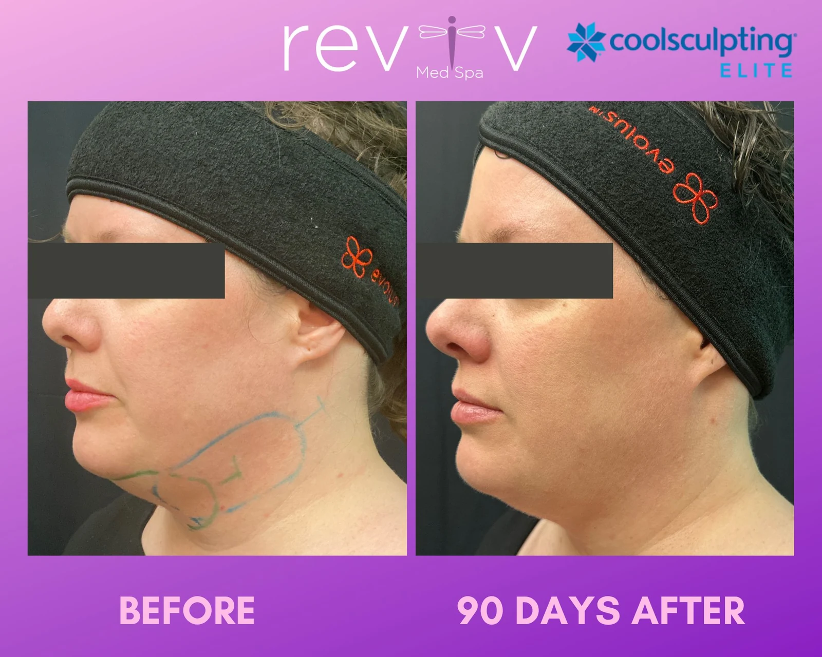 CoolSculpting body contouring result
