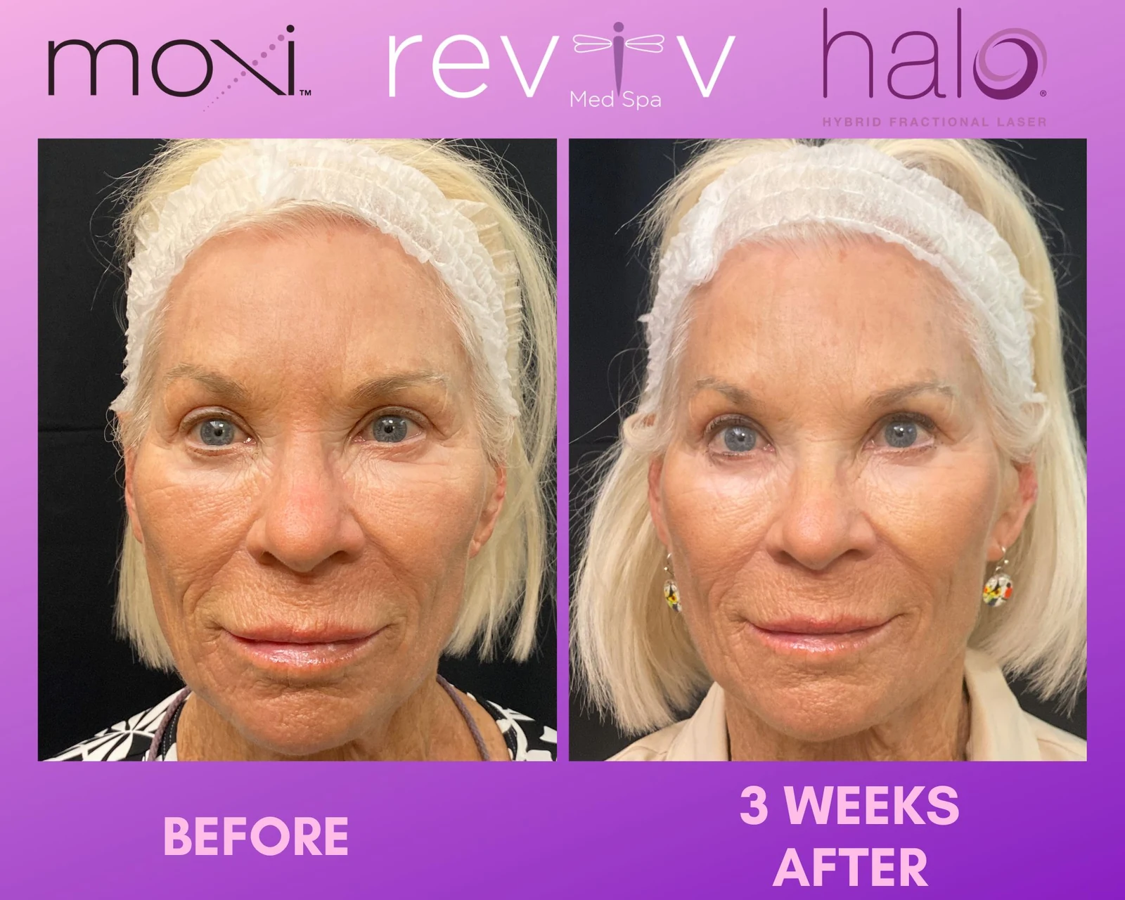 Moxi Halo three-week result