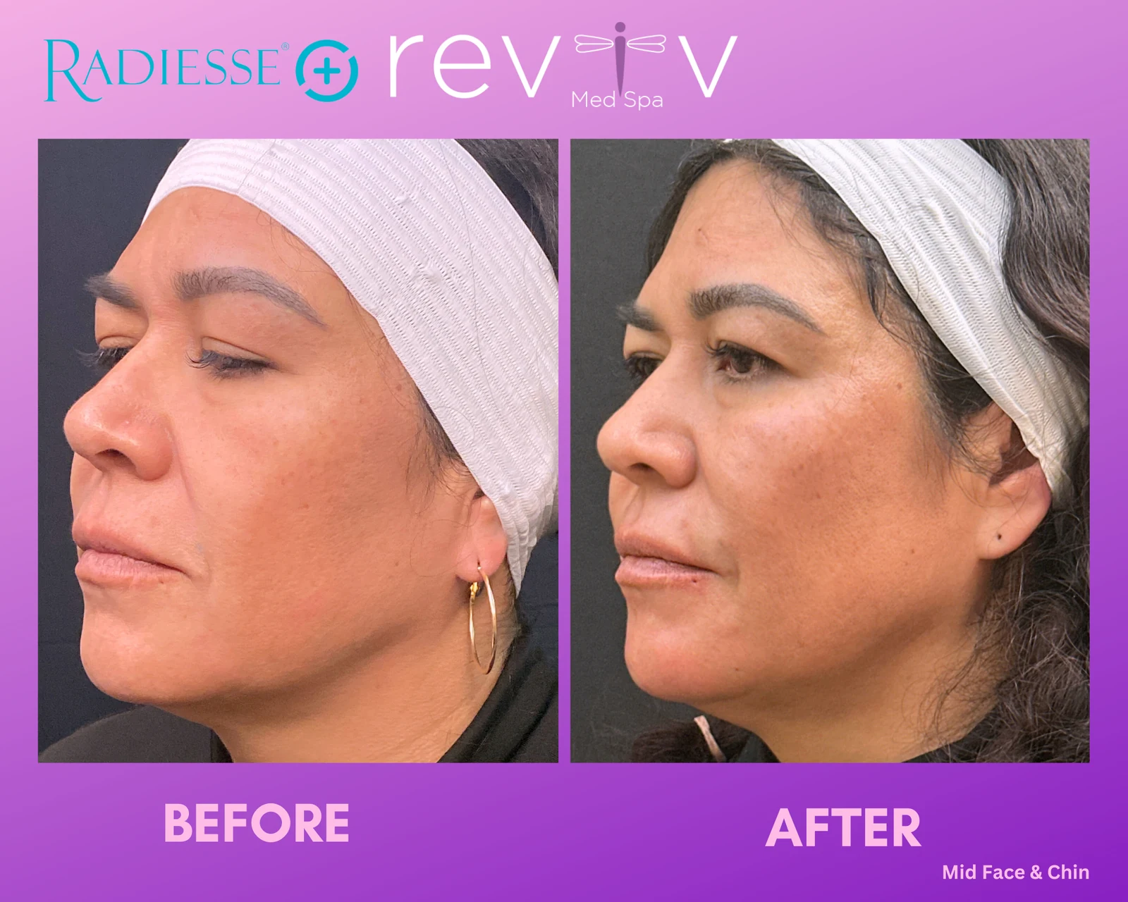 Dermal Fillers · mid-face & chin
