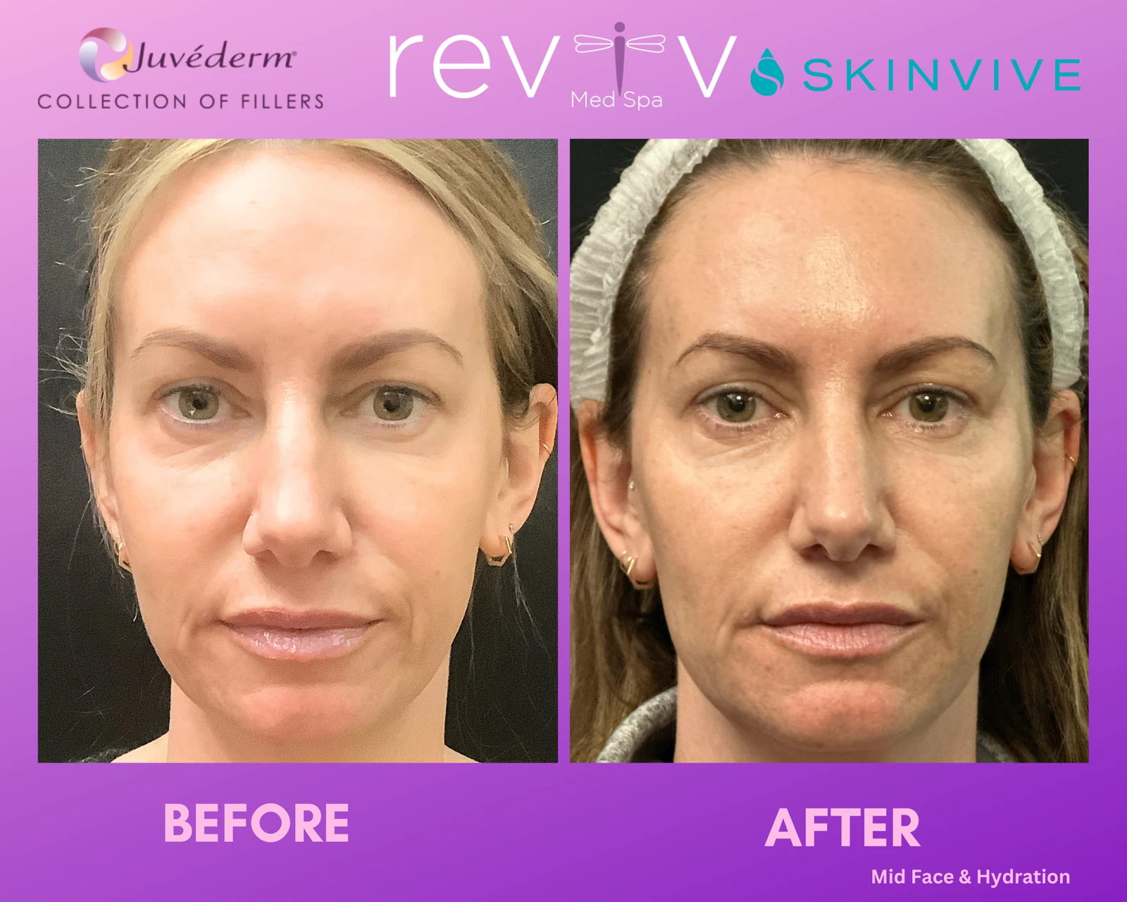 Reviv patient — Skinvive (undefined)