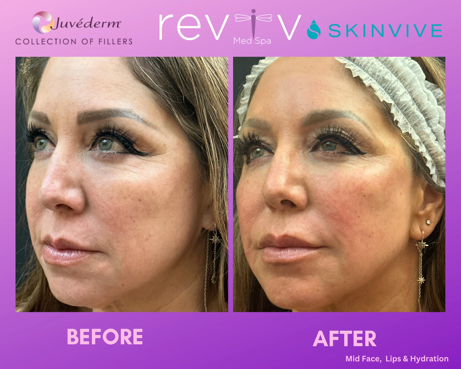 Dermal Fillers · midface volume