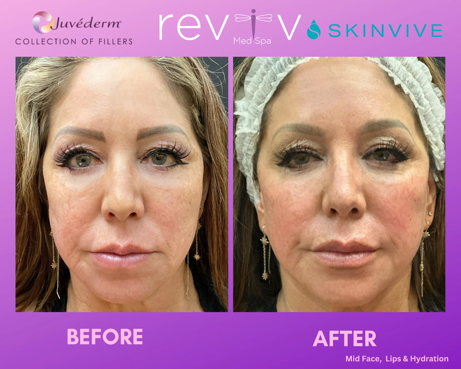 Dermal Fillers · jawline definition