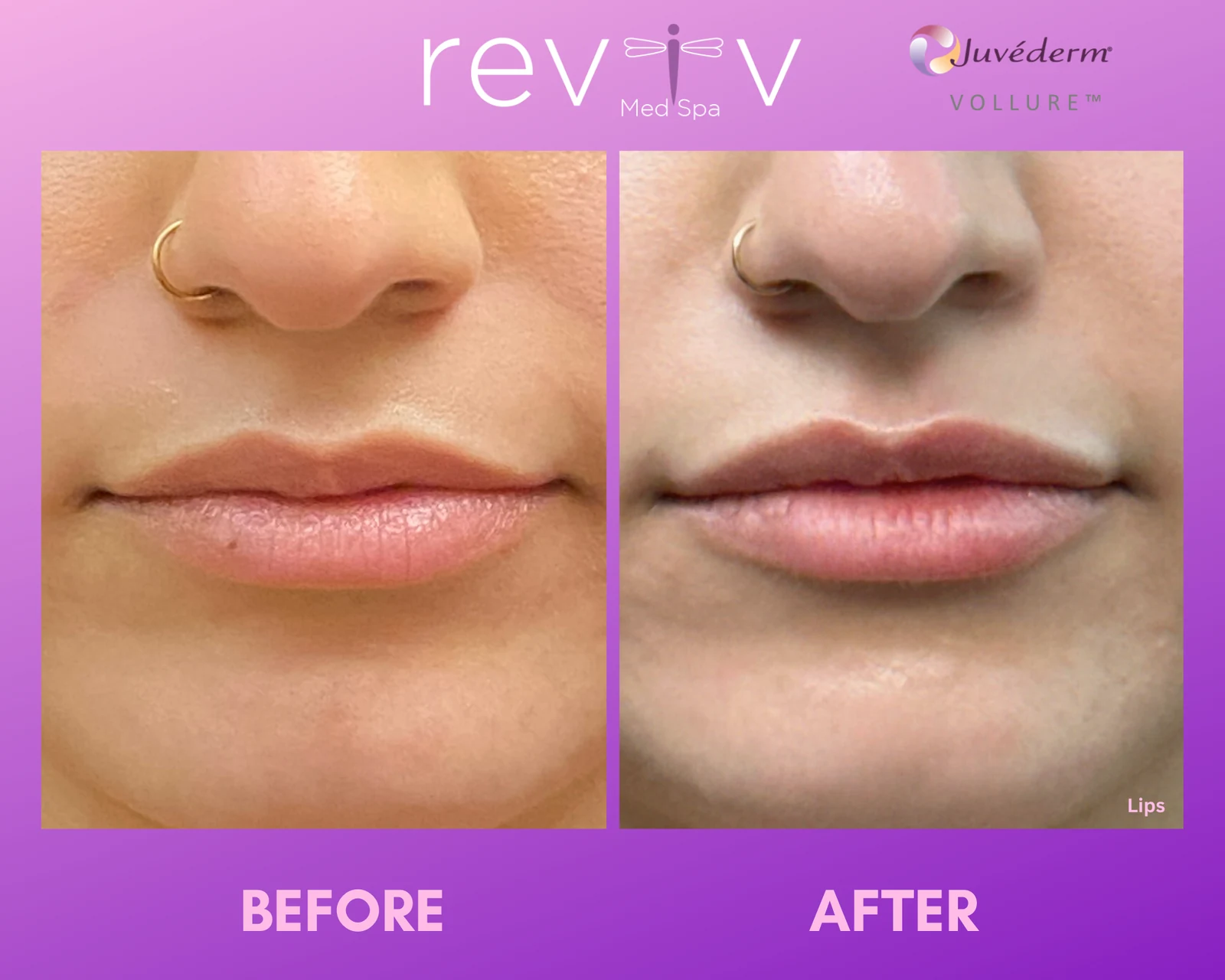 Reviv patient — Dermal Fillers (undefined)