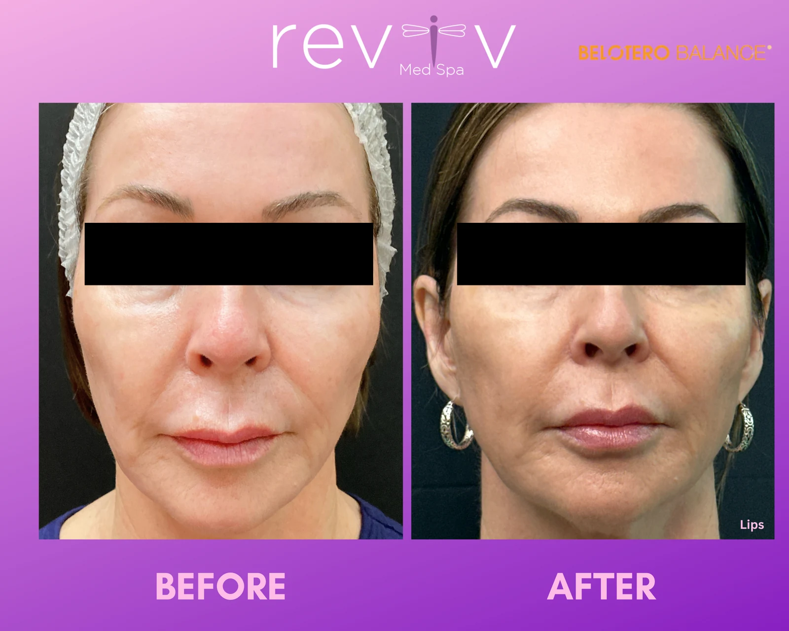 Reviv patient — Dermal Fillers (undefined)
