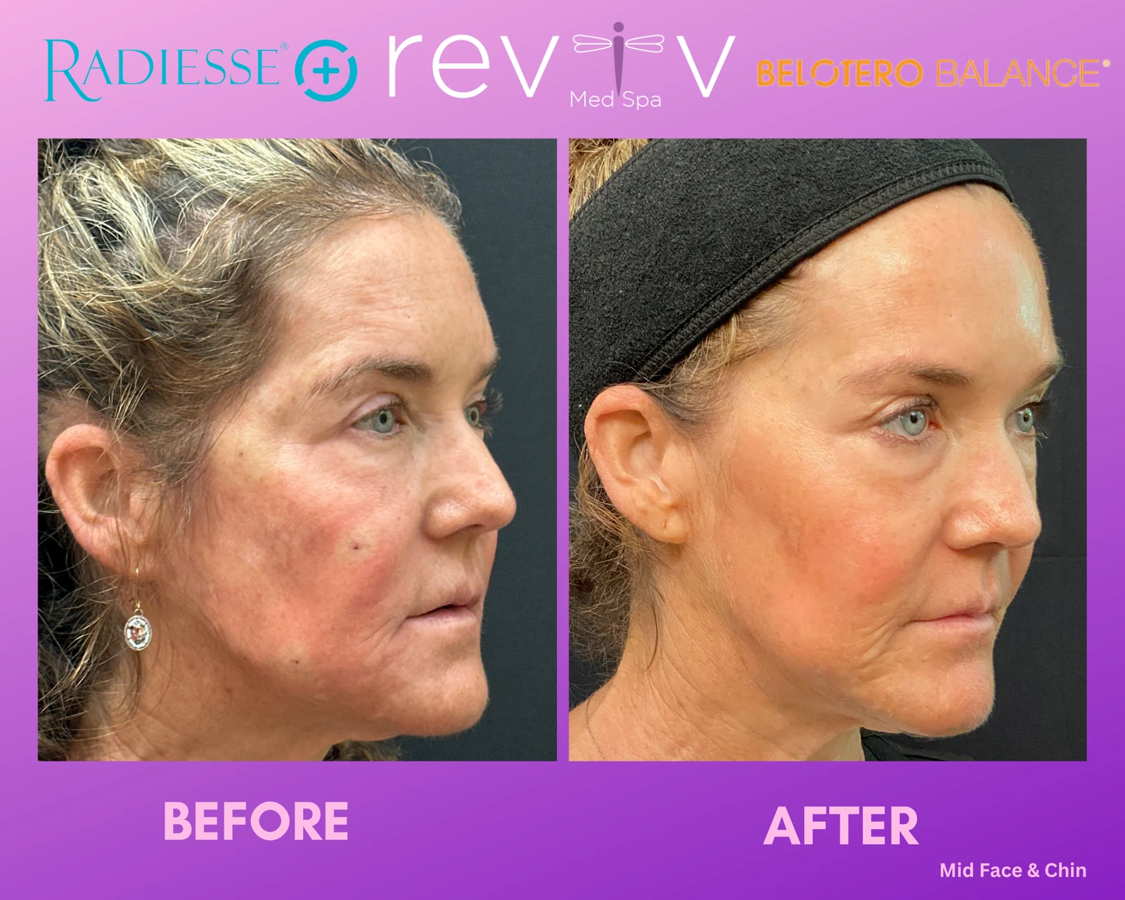 Reviv patient — Dermal Fillers (undefined)