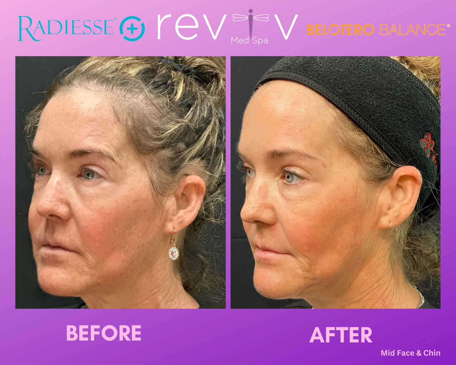 Reviv patient — Dermal Fillers (undefined)