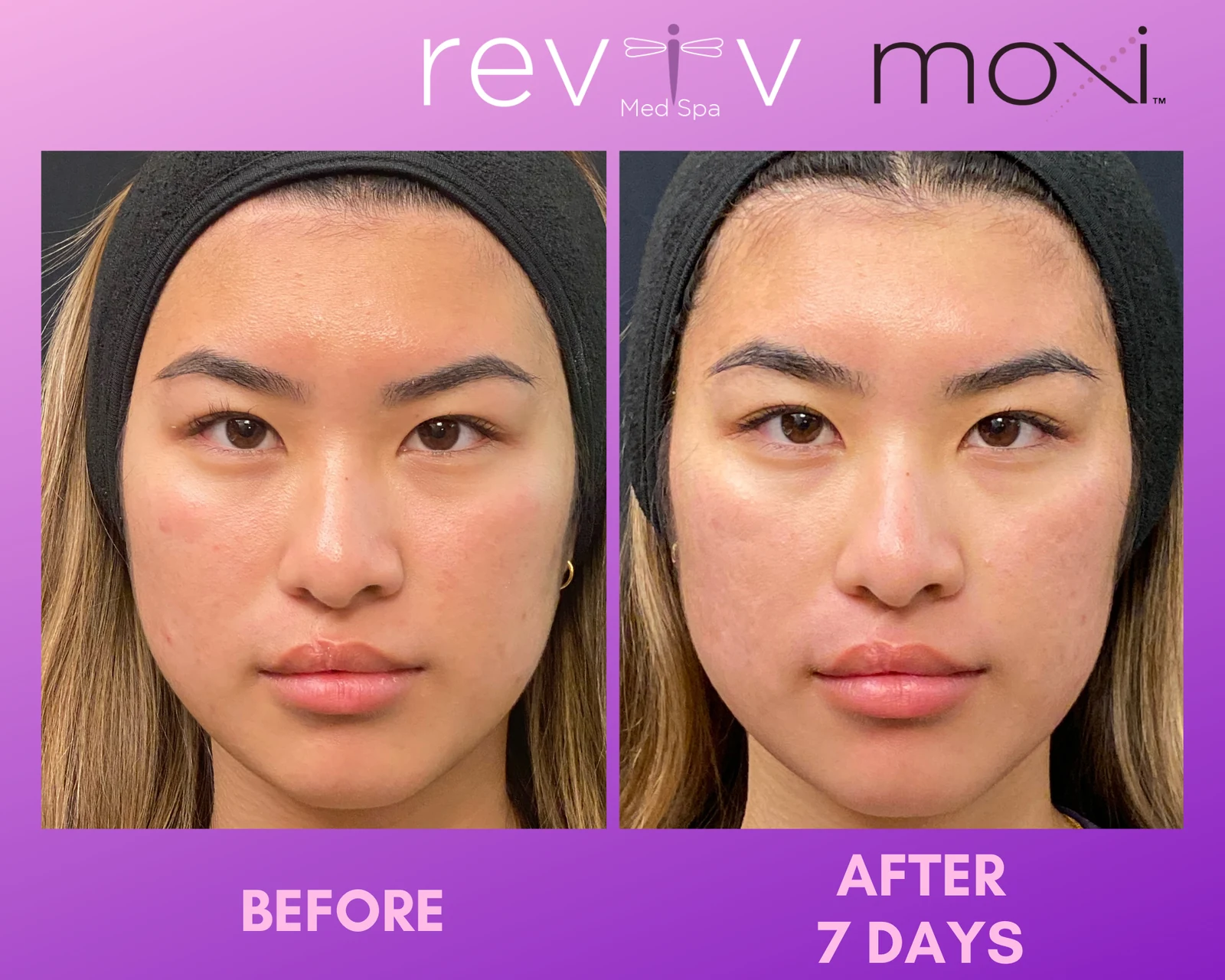 Reviv patient — MOXI (undefined)