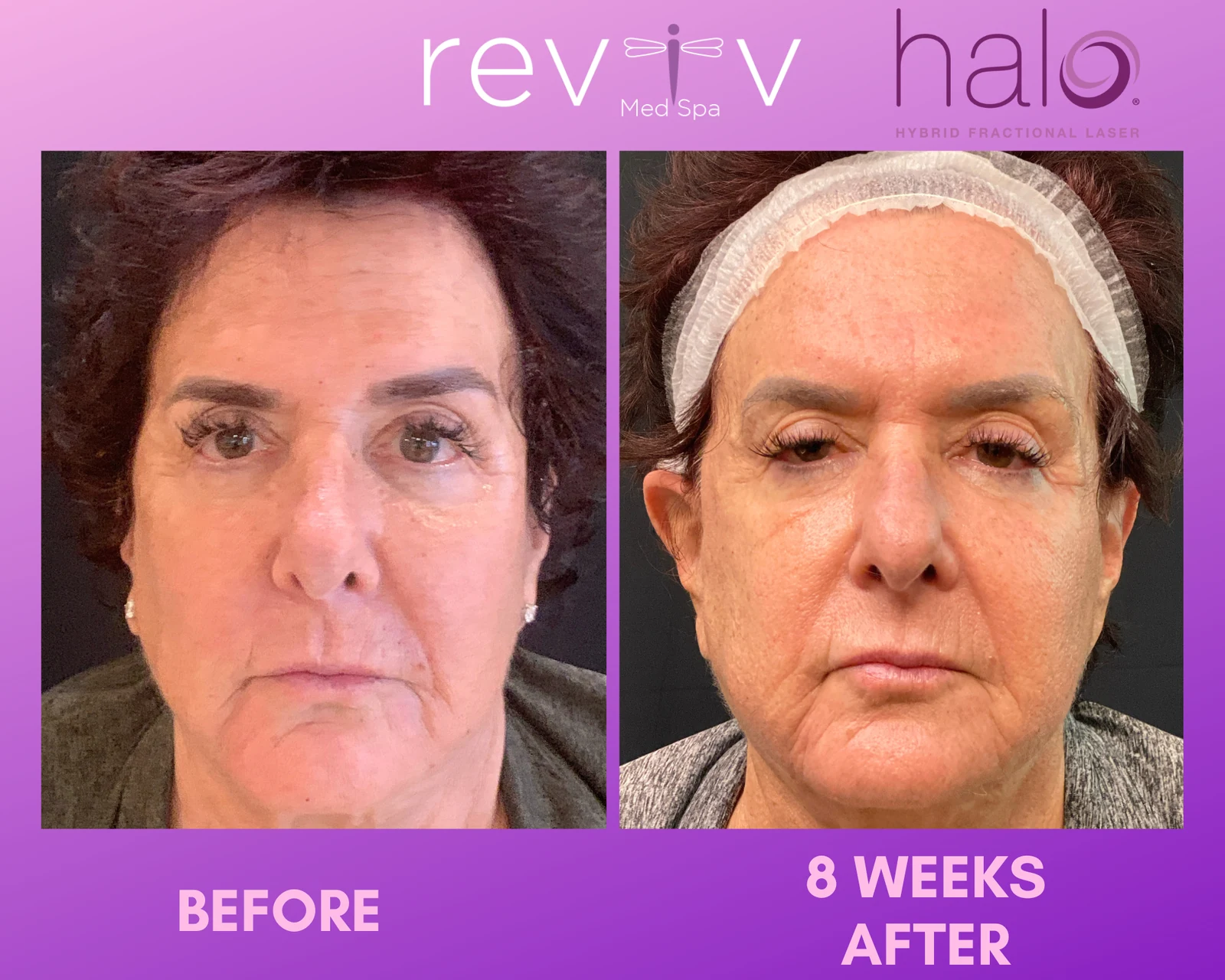 Reviv patient — Halo (undefined)