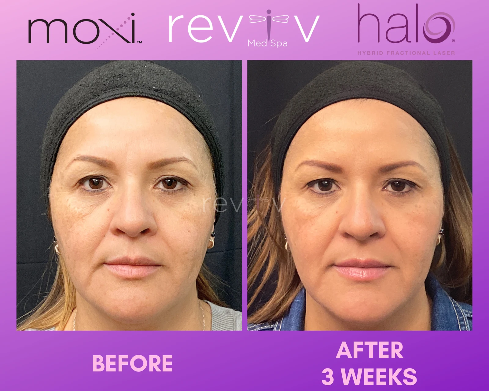 Reviv patient — Halo + MOXI (undefined)