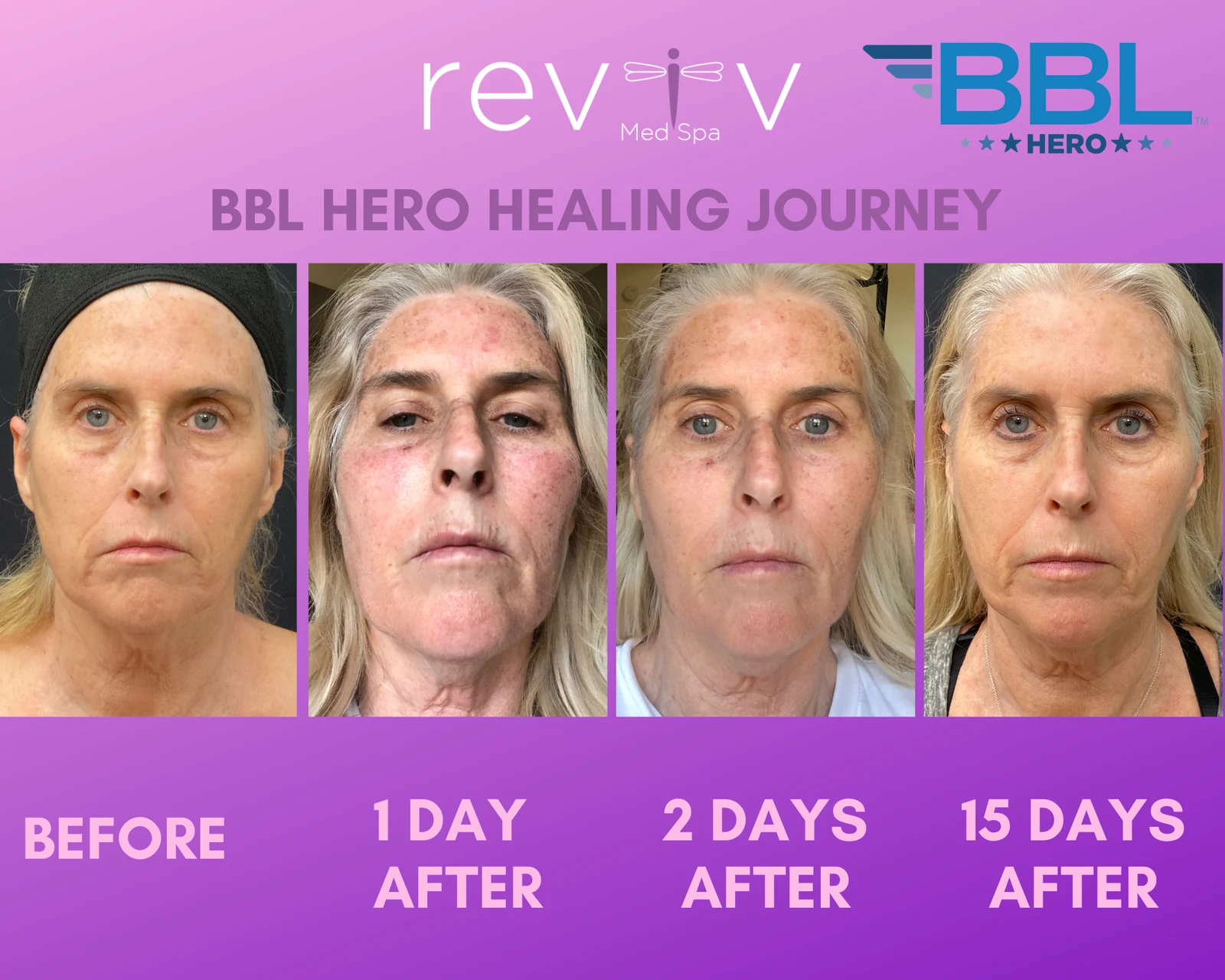 BBL Hero · sun damage