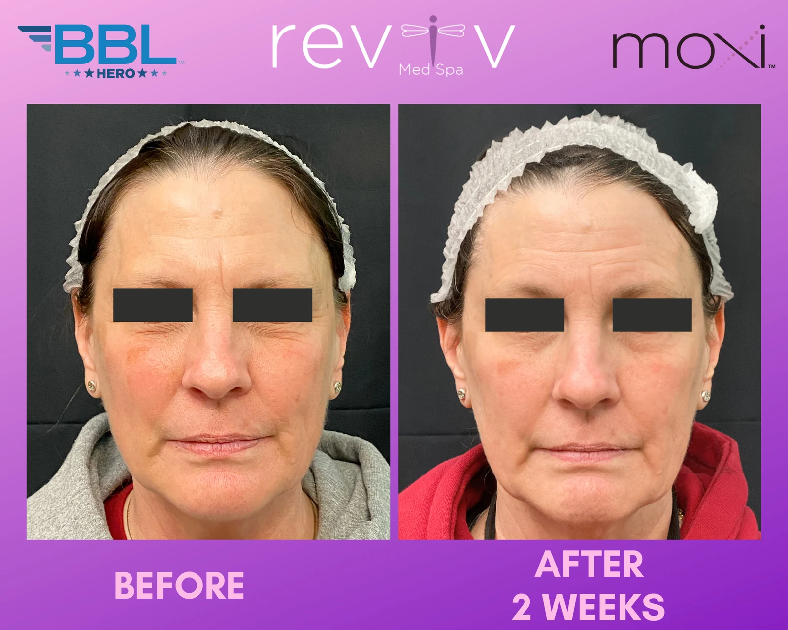 Reviv patient — BBL + MOXI (undefined)