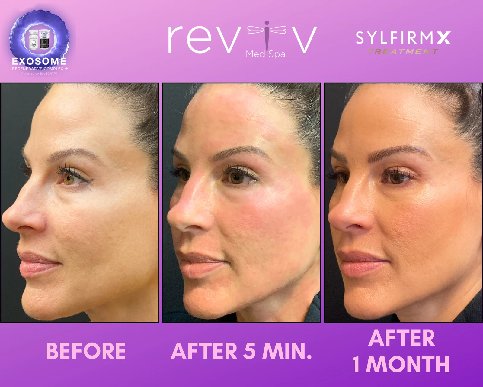 Sylfirm X · pigment + redness