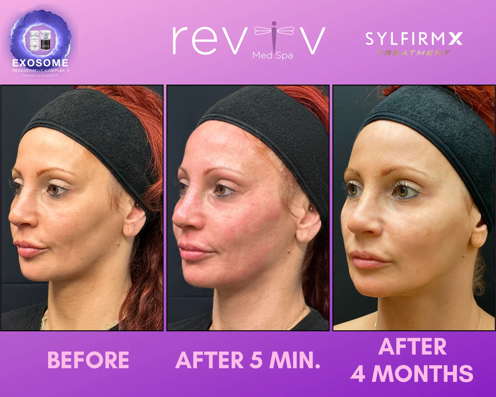 Reviv patient — Sylfirm X (undefined)