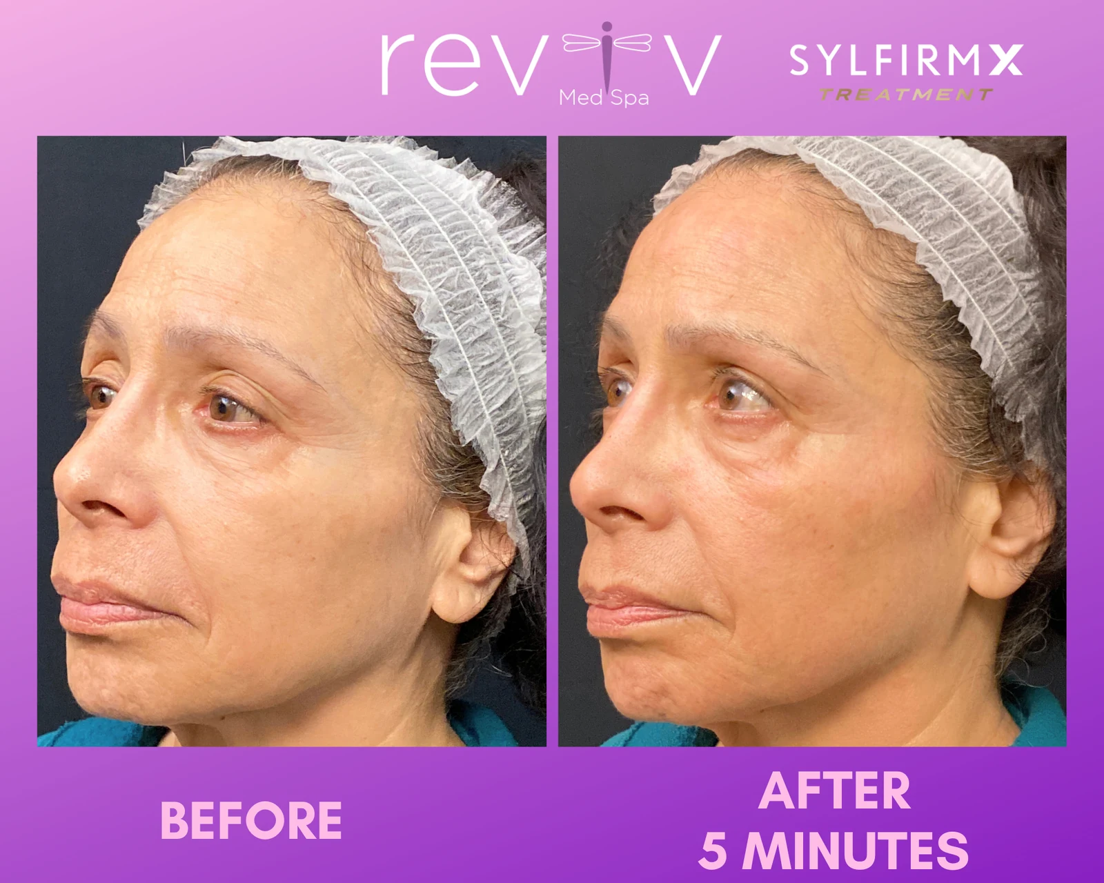 Reviv patient — Sylfirm X (undefined)