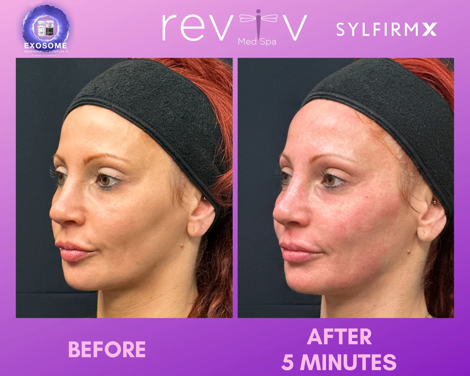 Reviv patient — Sylfirm X (undefined)