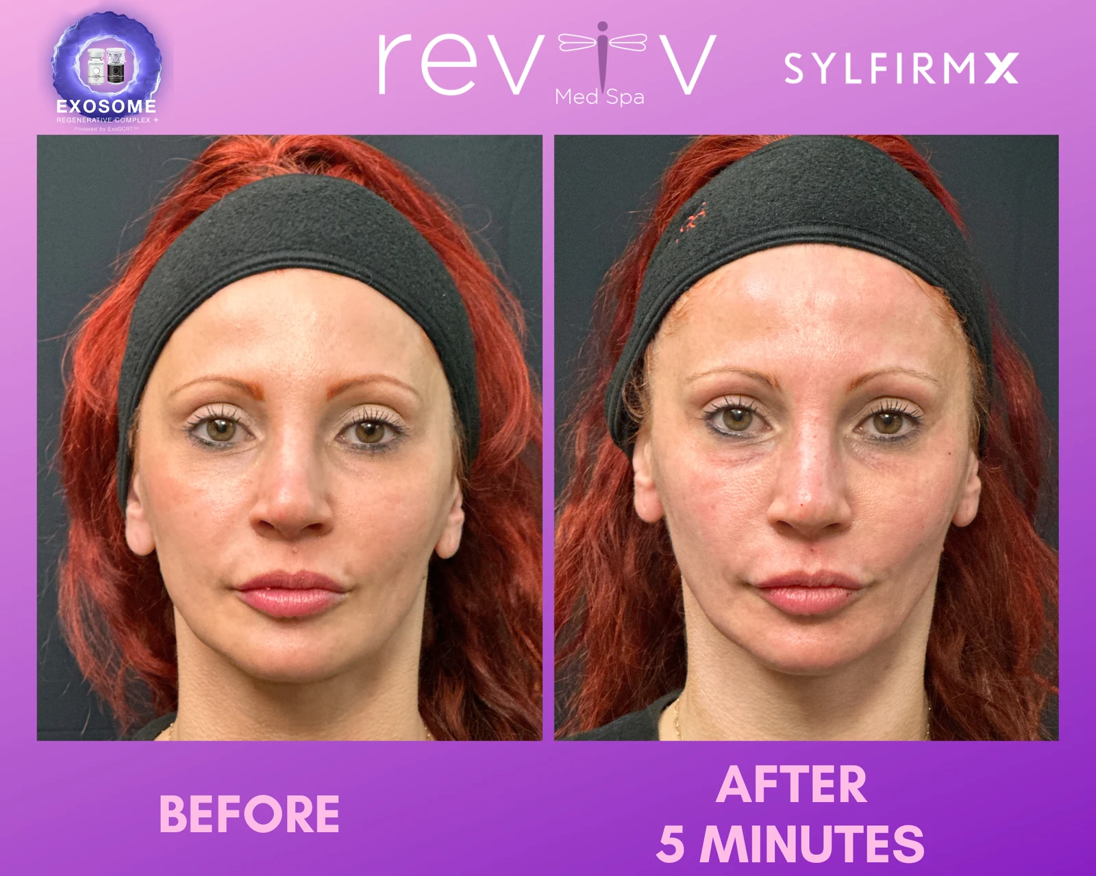 Reviv patient — Sylfirm X (undefined)
