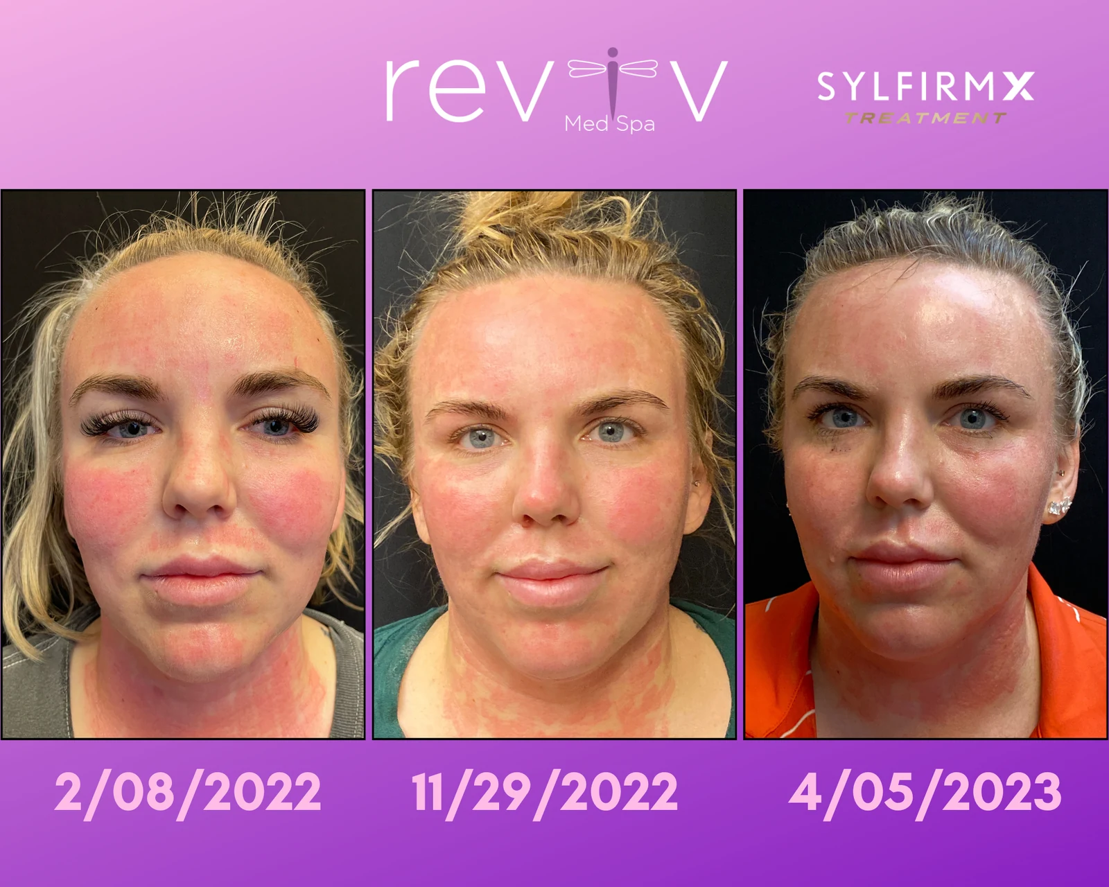 Reviv patient — Sylfirm X (undefined)