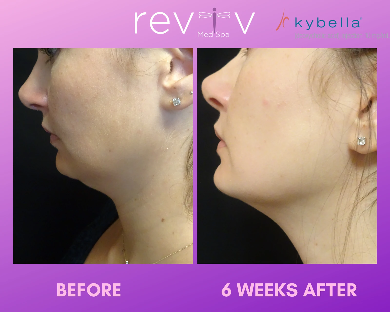 Kybella · submental — 4 sessions