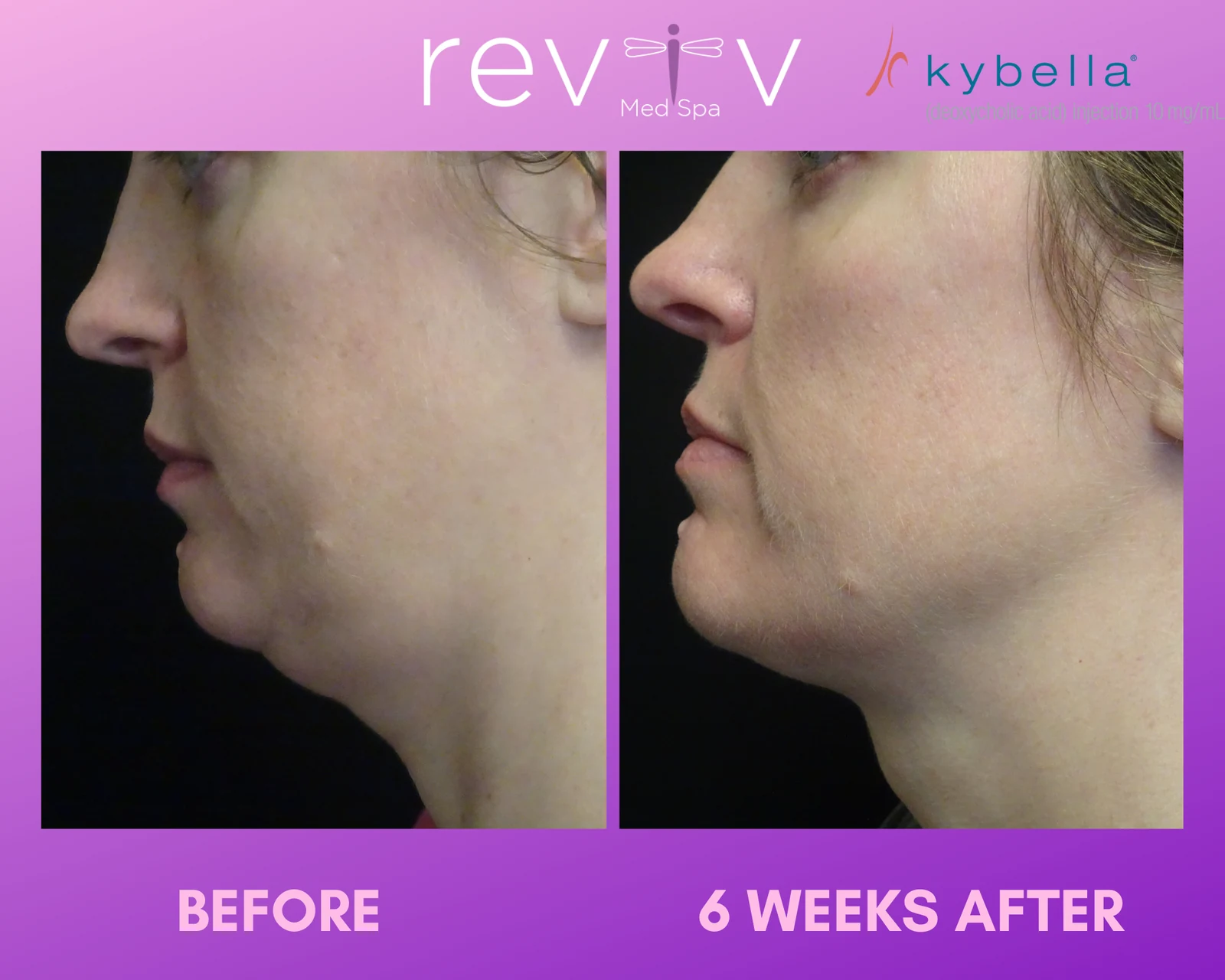 Kybella · profile change
