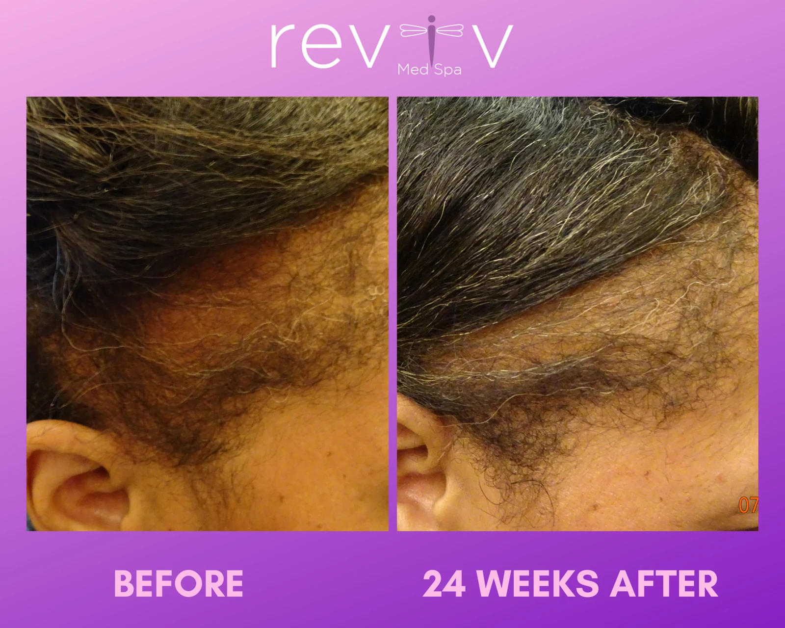 PRP scalp · 6 months