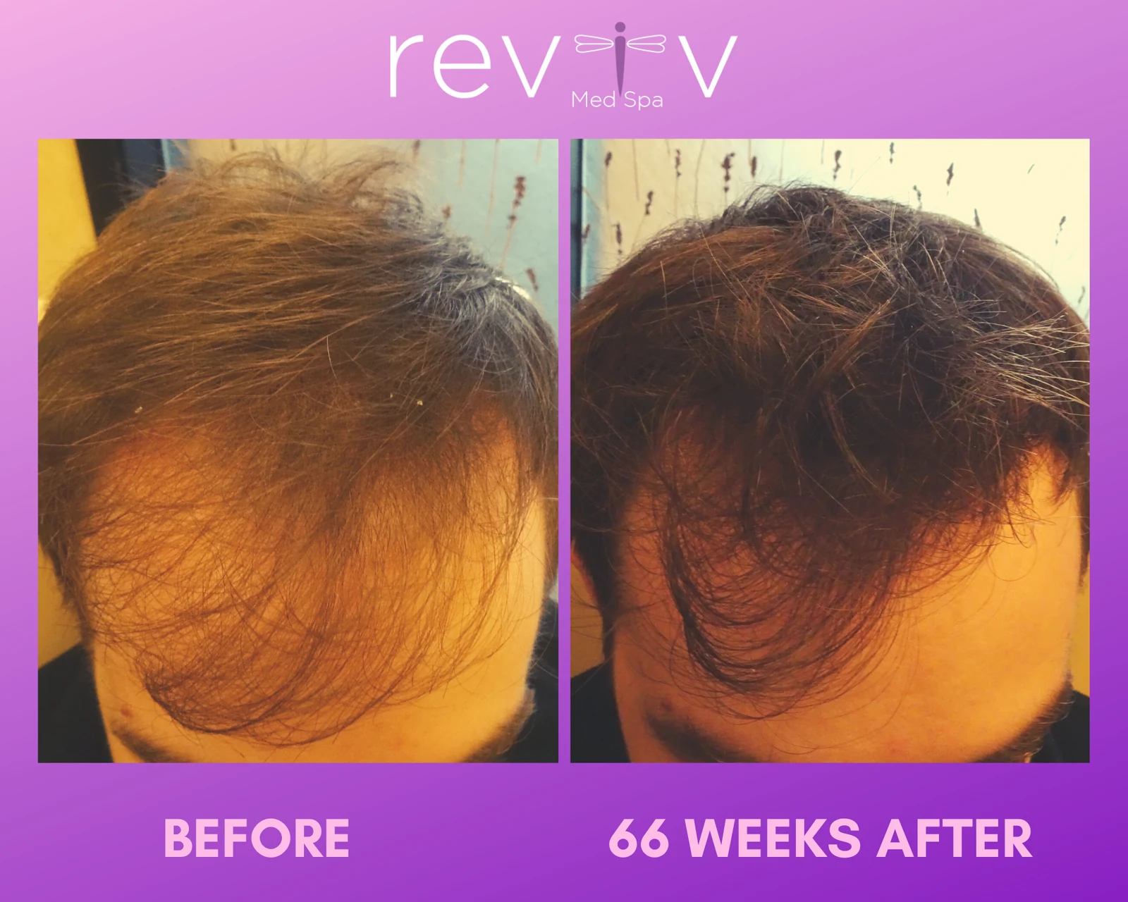 PRP scalp · 9 months