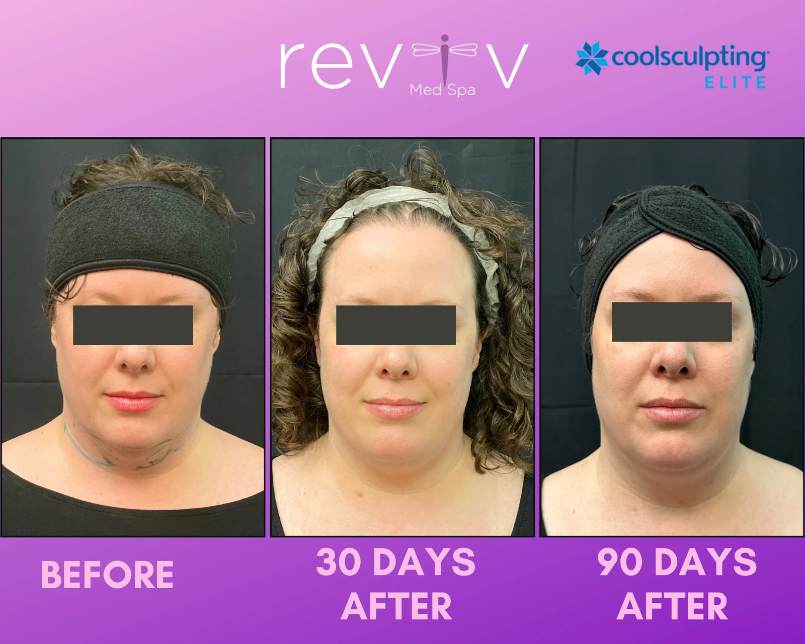 CoolSculpting Elite · post-second cycle