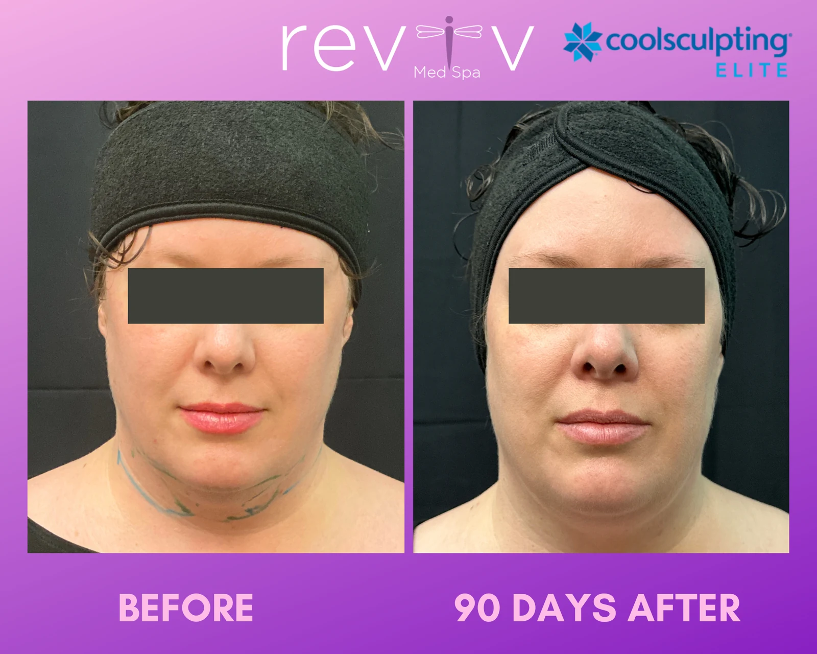 Reviv patient — CoolSculpting Elite (undefined)