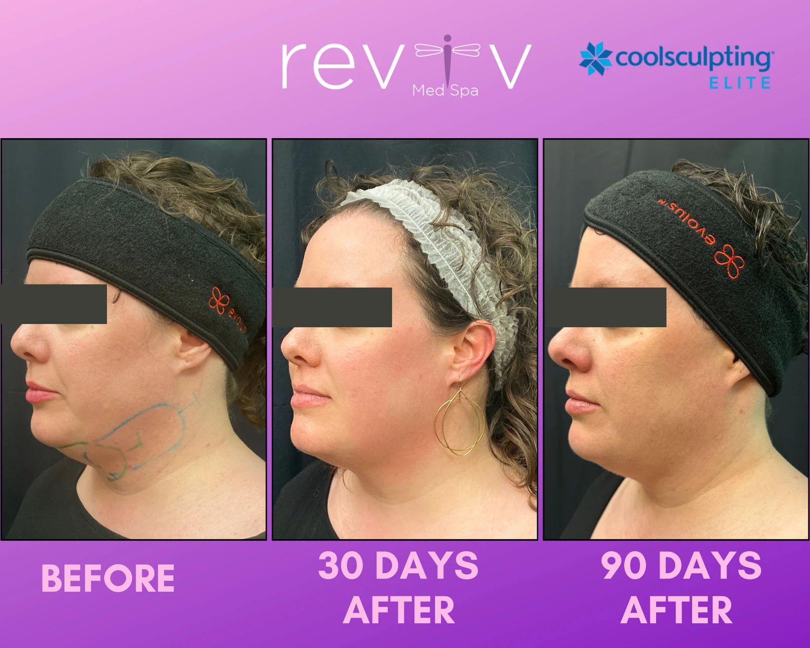 Reviv patient — CoolSculpting Elite (undefined)