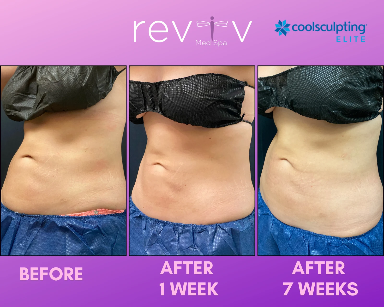 Reviv patient — CoolSculpting Elite (undefined)
