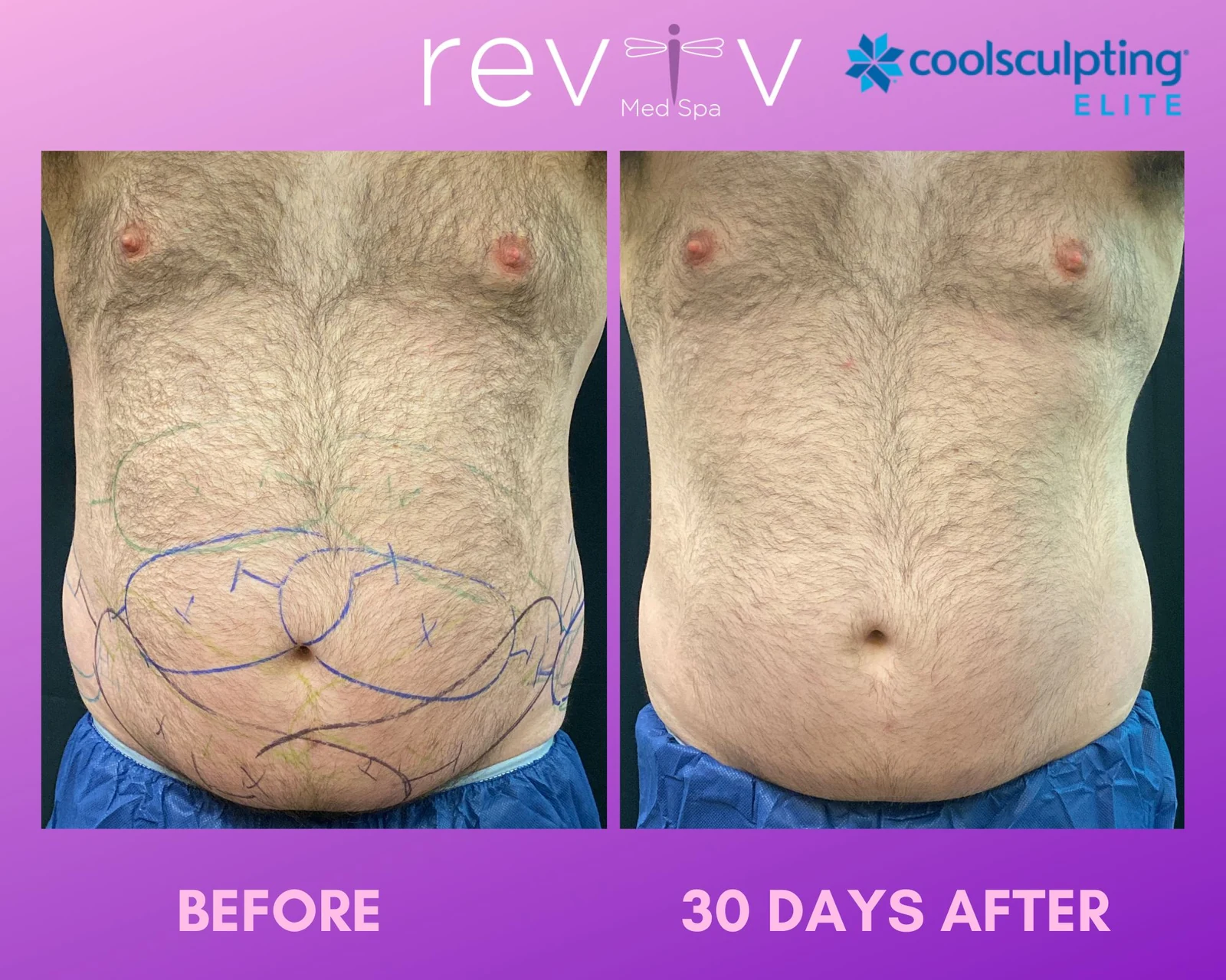 Reviv patient — CoolSculpting Elite (undefined)