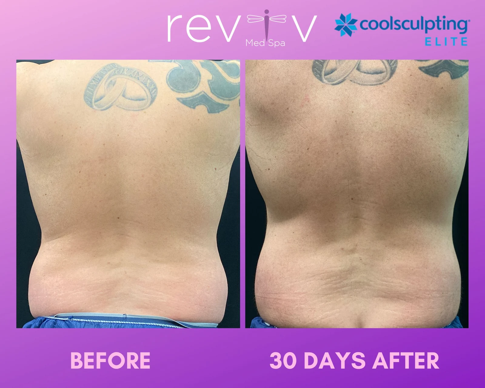 Reviv patient — CoolSculpting Elite (undefined)