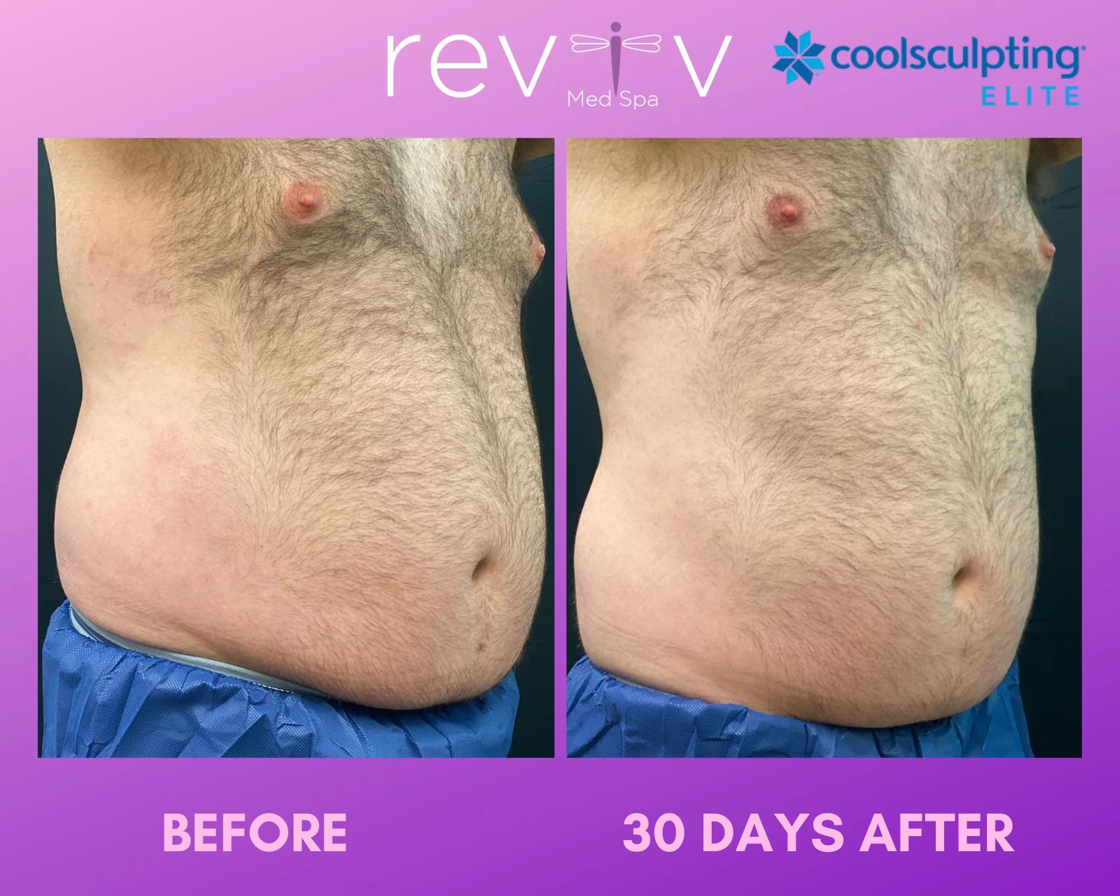 Reviv patient — CoolSculpting Elite (undefined)