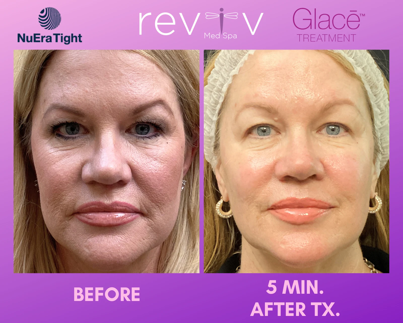 Reviv patient — Glace Hydrafacial (undefined)