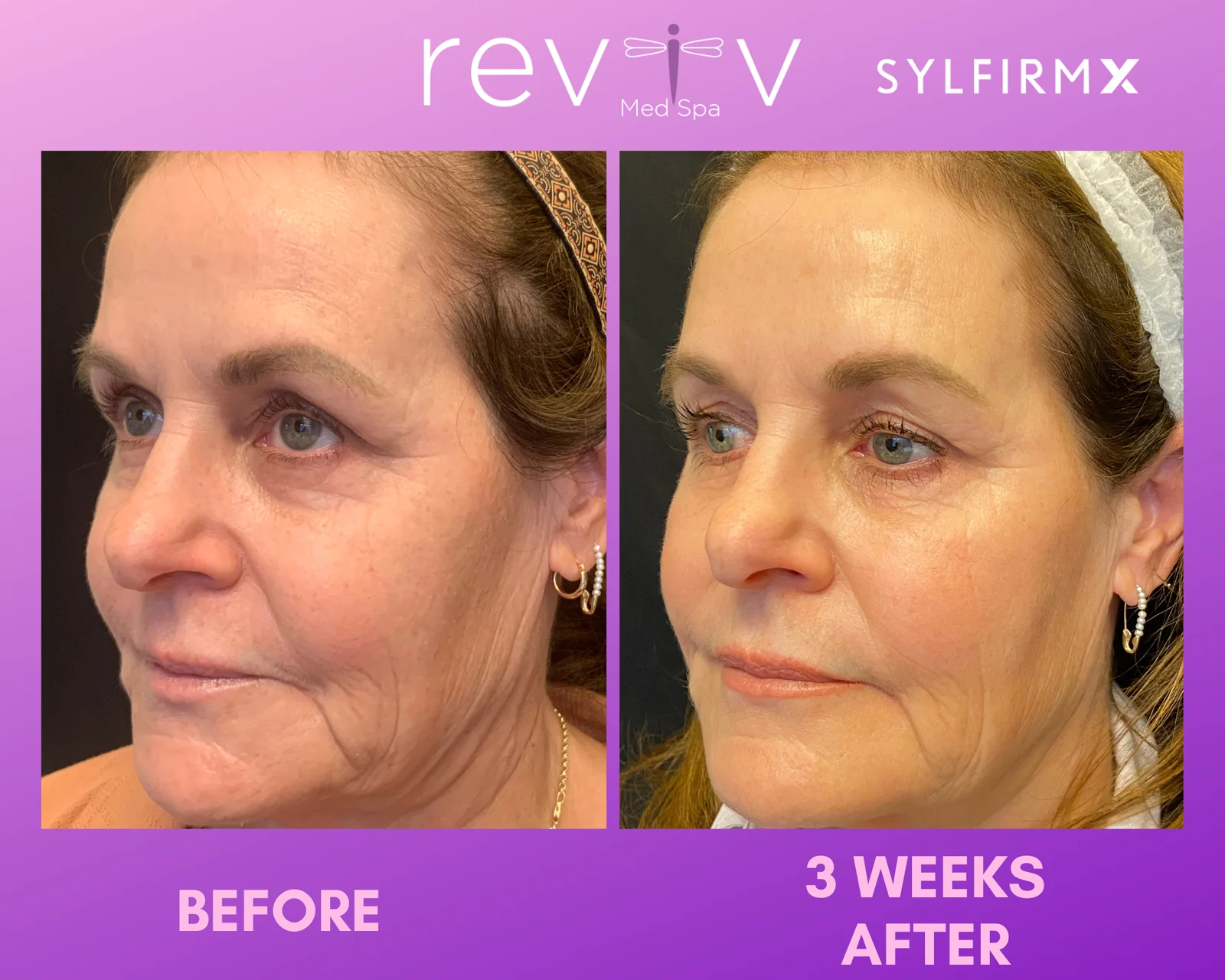 Reviv patient — Sylfirm X (undefined)