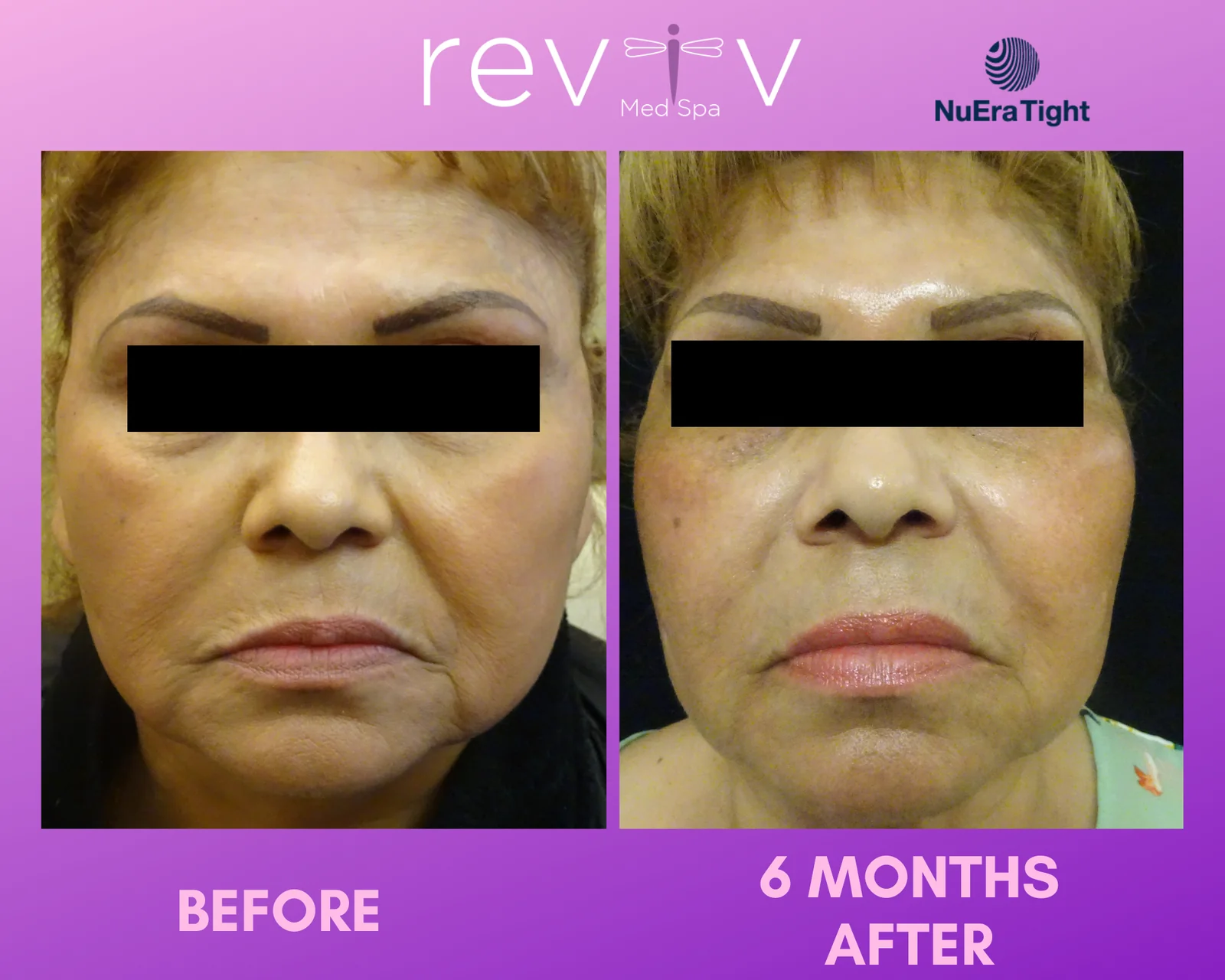 Reviv patient — NuEra Tight RF (undefined)