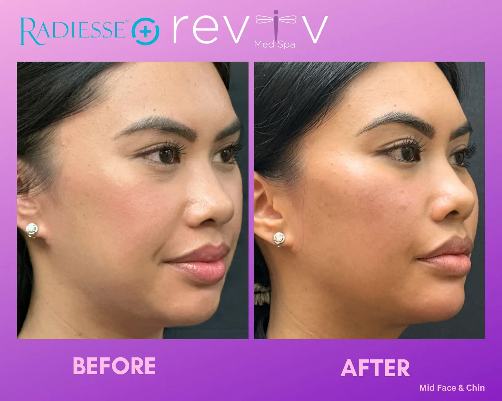 Radiesse · jawline + profile contour
