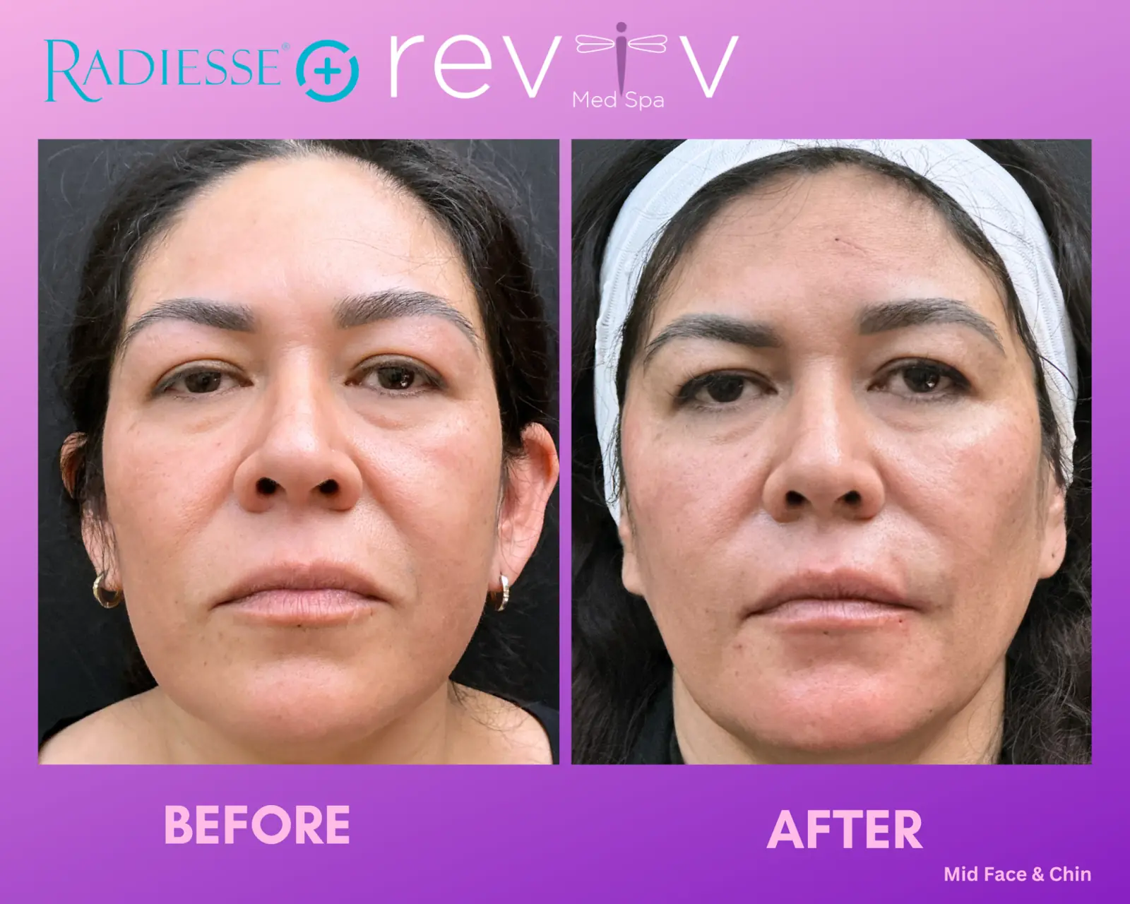 Radiesse · midface + chin