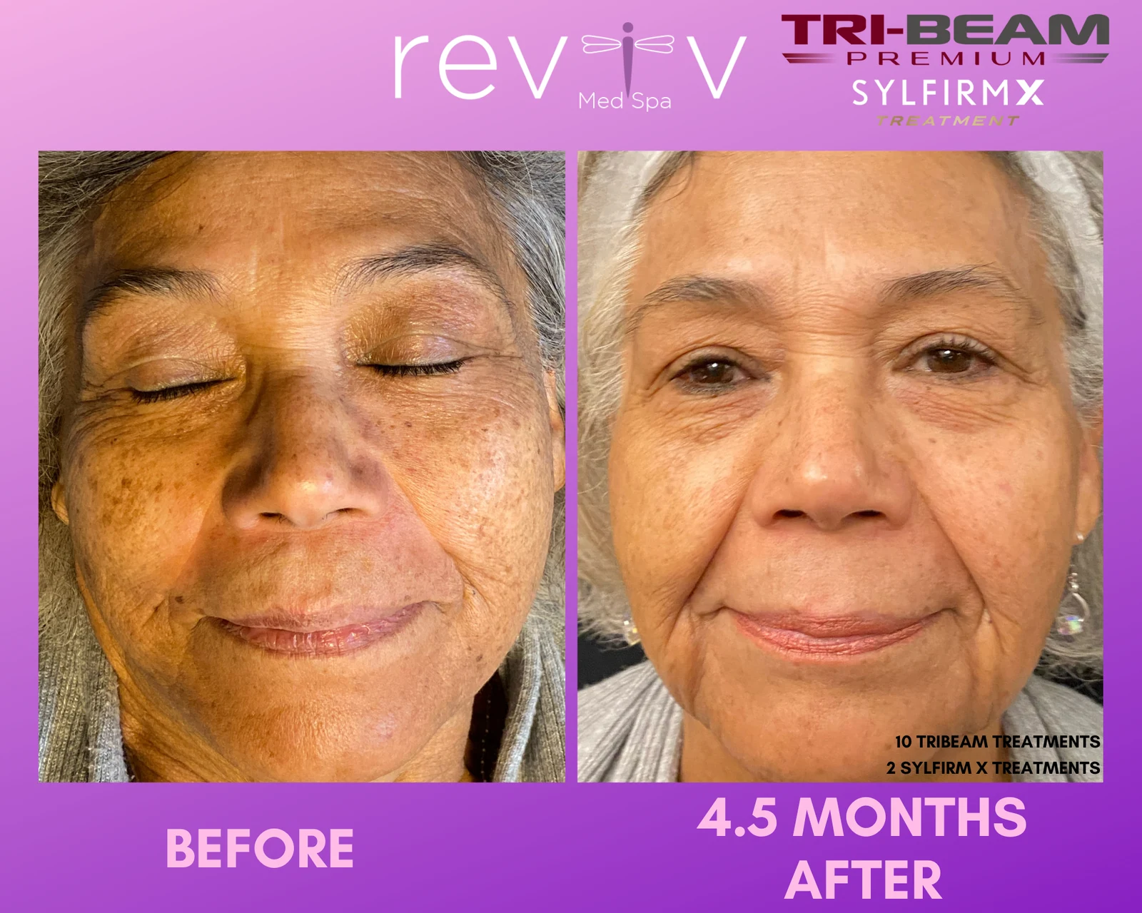 Reviv Med Spa patient before and after — Sylfirm + TriBeam, Millbrae, California