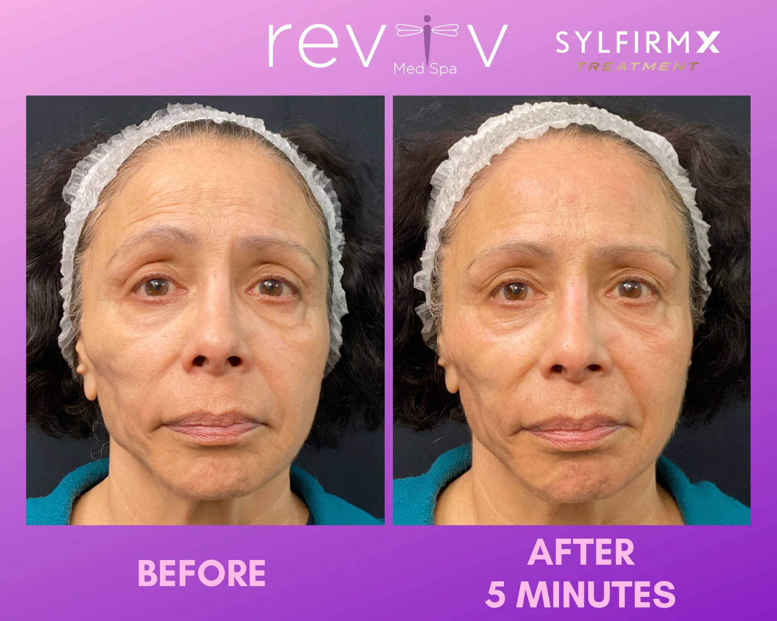 Reviv Med Spa patient before and after — Sylfirm X, Millbrae, California